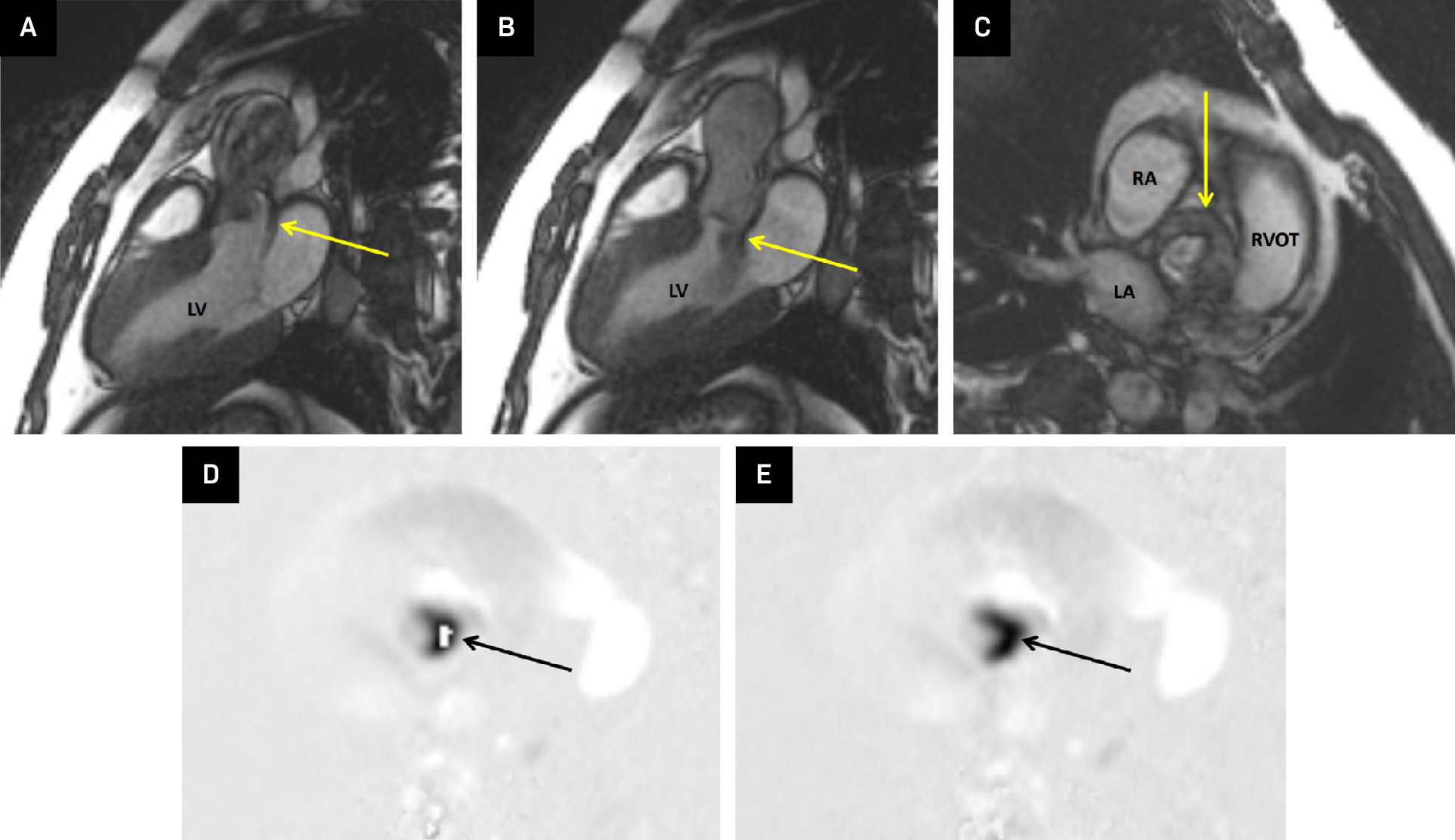 (A) A 3-chamber CMR cine steady-state free precession (SSFP) at peak systole shows systolic doming of the aortic valve with dephasing across the valve consistent with stenosis (yellow arrow). LV, left ventricle. (B) A 3-chamber CMR cine SSFP at end diastole shows aortic valve insufficiency (yellow arrow). LV, left ventricle. (C) Aortic valve en face CMR cine SSFP at peak systole shows a bicuspid aortic valve (yellow arrow). LA, left atrium; RA, right atrium; RVOT, right ventricular outflow tract. (D) Aortic valve en face CMR phase contrast through plane at peak systole shows aliasing across the aortic valve (black arrow). The velocity limit set on the sequence is 300 cm/second, and the aliasing (white pixels in the middle of the black pixels) indicates the velocity across the valve is higher than 300 cm/second. (E) Aortic valve en face CMR phase contrast through plane at peak systole shows resolution of the aliasing across the aortic valve (black arrow). The velocity limit set on the sequence is 400 cm/second, and the resolution of the previously seen aliasing (uniform black pixels) indicates the velocity across the valve is between 300 and 400 cm/second.