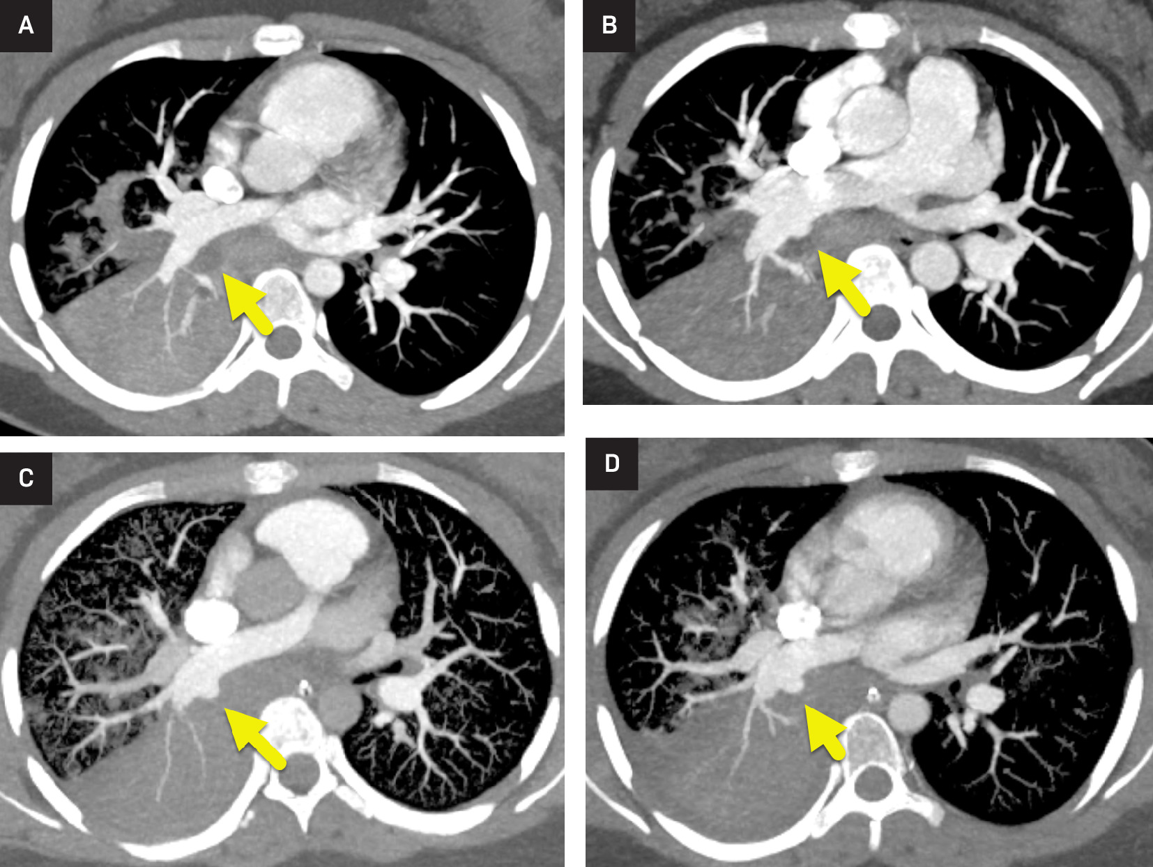 (A) Axial maximum intensity projection images from CT pulmonary angiogram performed at admission during the initial onset of hemoptysis, (B) 7 days later, at the onset of massive hemoptysis, (C) 9 days after the initial CT, and (D) 11 days after the initial CT. All scans show consolidation of the right lower lobe and patchy areas of opacity in other lobes. On the first image, there is a local, more hypodense region (arrow in A) within the right lower lobe consolidation, posterior to the right pulmonary artery. Later images show a pseudoaneurysm (arrow in B-D) forming and growing at this location.