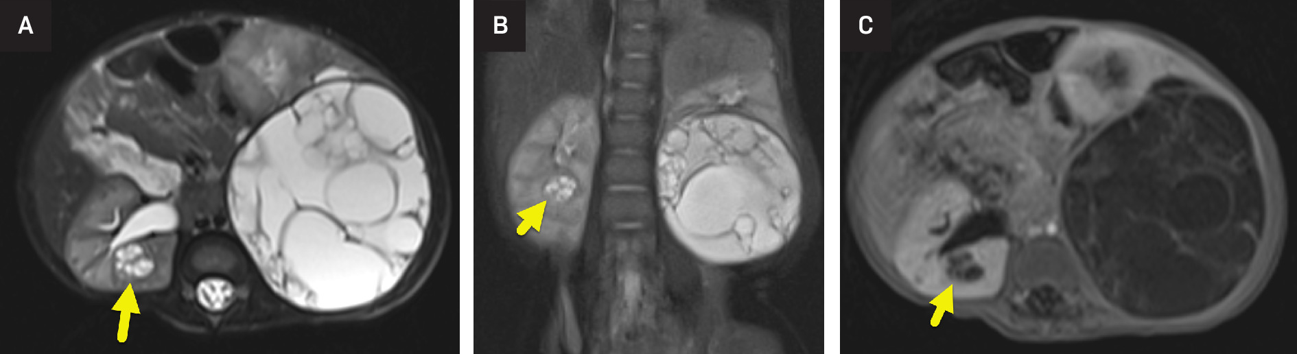 (A) Axial and (B) coronal T2-weighted MRI of the abdomen shows a dominant multiseptated cystic mass of the left kidney and a similar-appearing smaller mass (arrow) of the right kidney. (C) The mass does not enhance on post-contrast T1-weighted MRI.