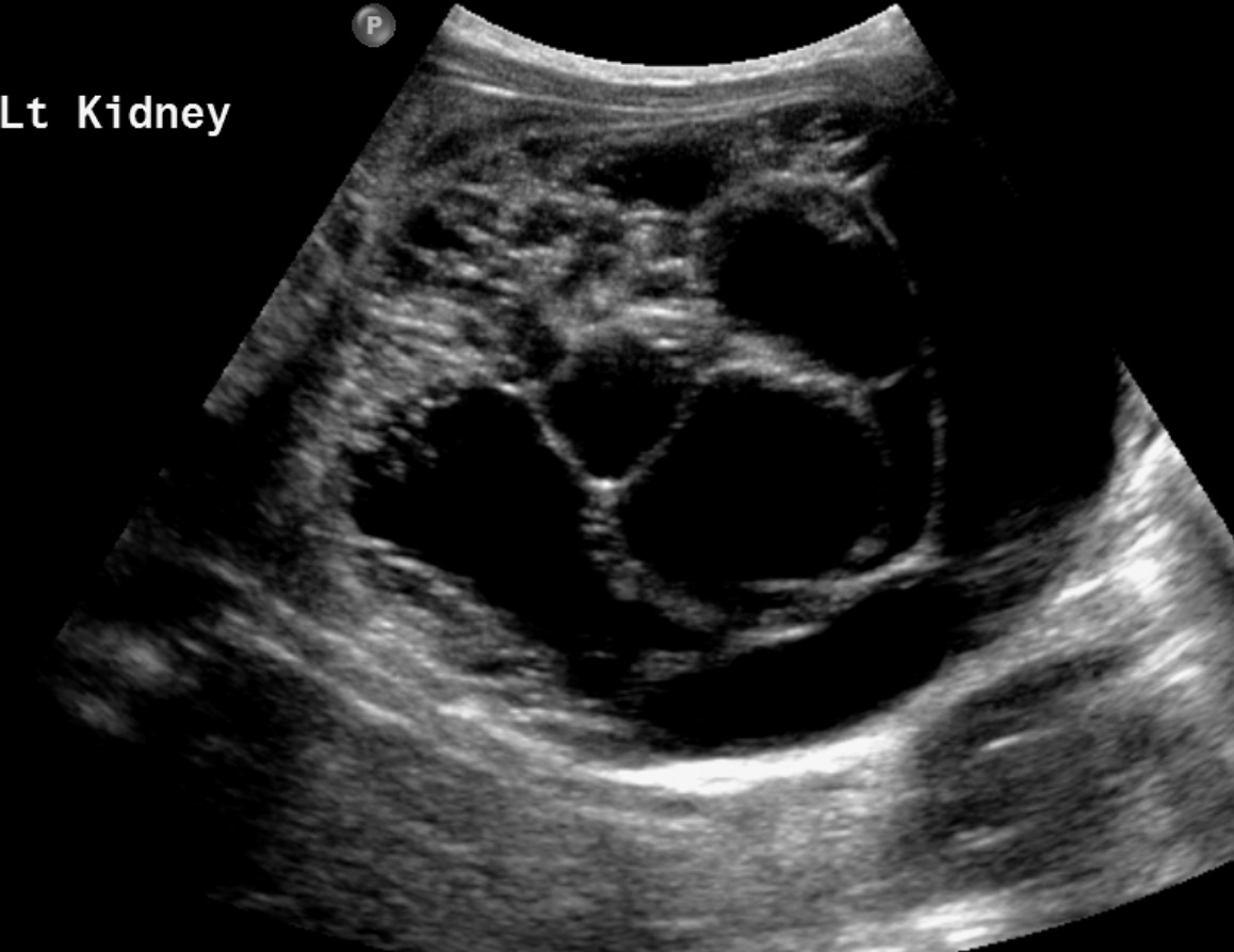 Longitudinal US image performed after the initiation of therapy shows the multiseptated cystic mass of the left kidney.