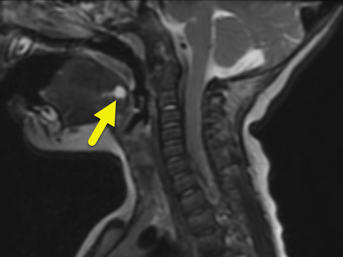 Sagittal T2-weighted MRI shows a small cystic mass (arrow) at the root of the tongue.