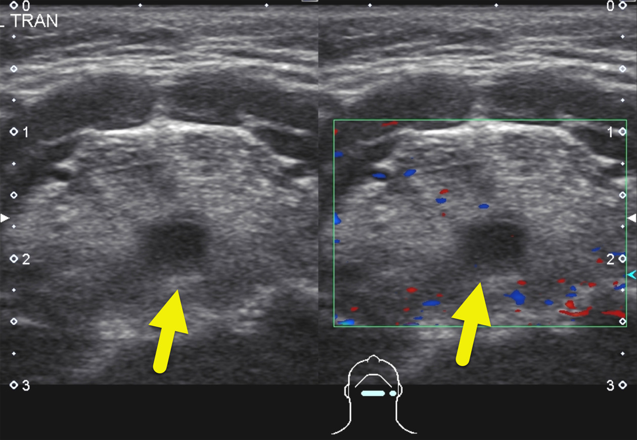 Transverse US images at the root of the tongue show the small hypoechoic cystic mass (arrow). There is no internal color Doppler flow within the lesion (right side of the image).