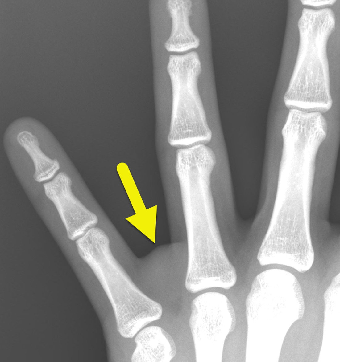 Magnified radiograph of the hand shows a soft tissue mass (arrow) in the web space between the ring and small fingers. A small amount of relatively lucent fat is present on the more proximal aspect of the tumor.