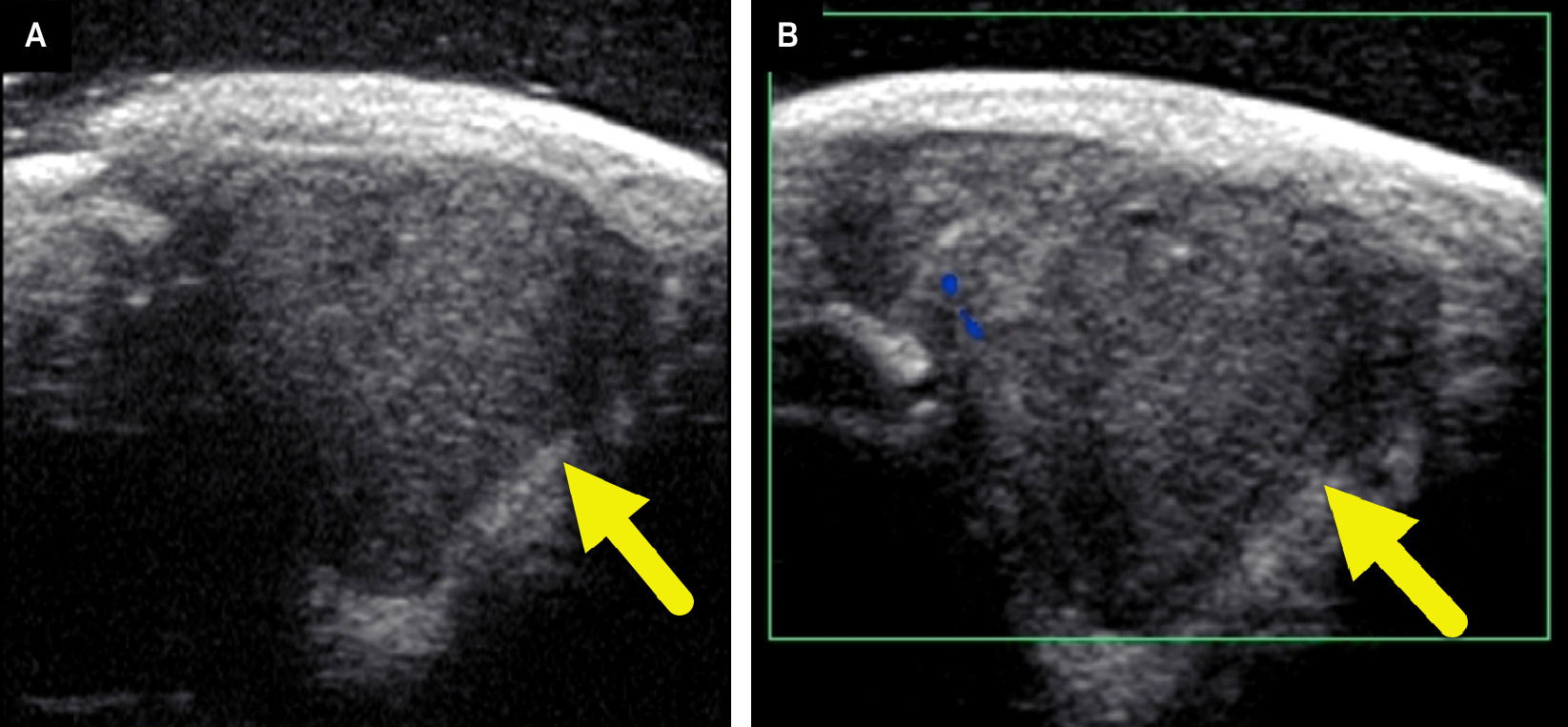 (A) US of the soft tissue mass shows a solid hypoechoic lesion (arrow) at the area of concern. There is a small amount of echogenic fat along the lateral and deep margins of the tumor. (B) Color Doppler US shows minimal internal Doppler flow.