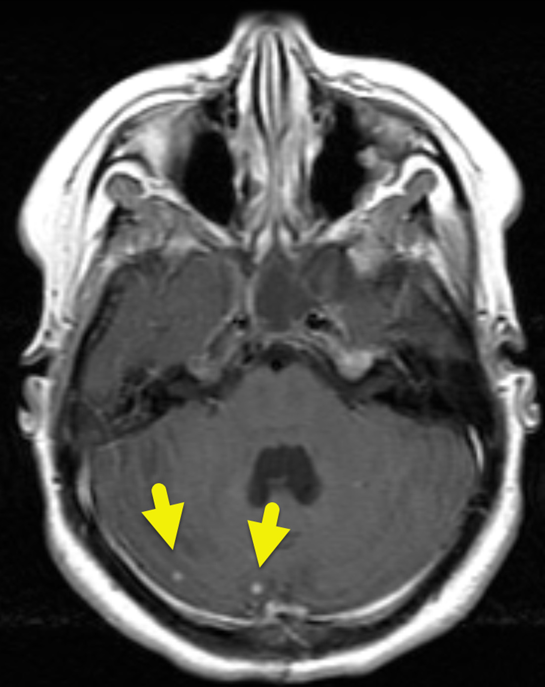 Axial T1-weighted MRI status post administration of contrast shows 2 small enhancing foci (arrows) within the right cerebellum.