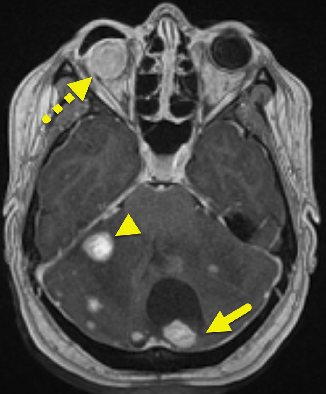 Axial T1-weighted MRI performed 7 years later shows that the cerebellar lesions have increased in size and number since the prior study. The largest lesion (arrow) has a cyst and mural nodule appearance. The remainder of the lesions (example arrowhead) are solid appearing. Note that the right eye (dashed arrow) has been enucleated.