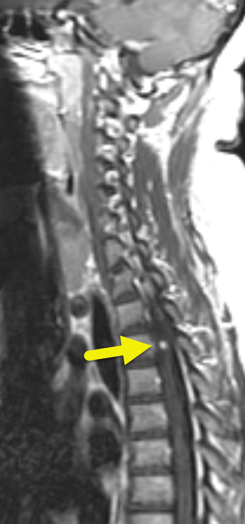 Sagittal T1-weighted post-contrast MRI performed 2 years after the initial MRI shows a small, enhancing focus (arrow) in the spinal cord at the T4 level.