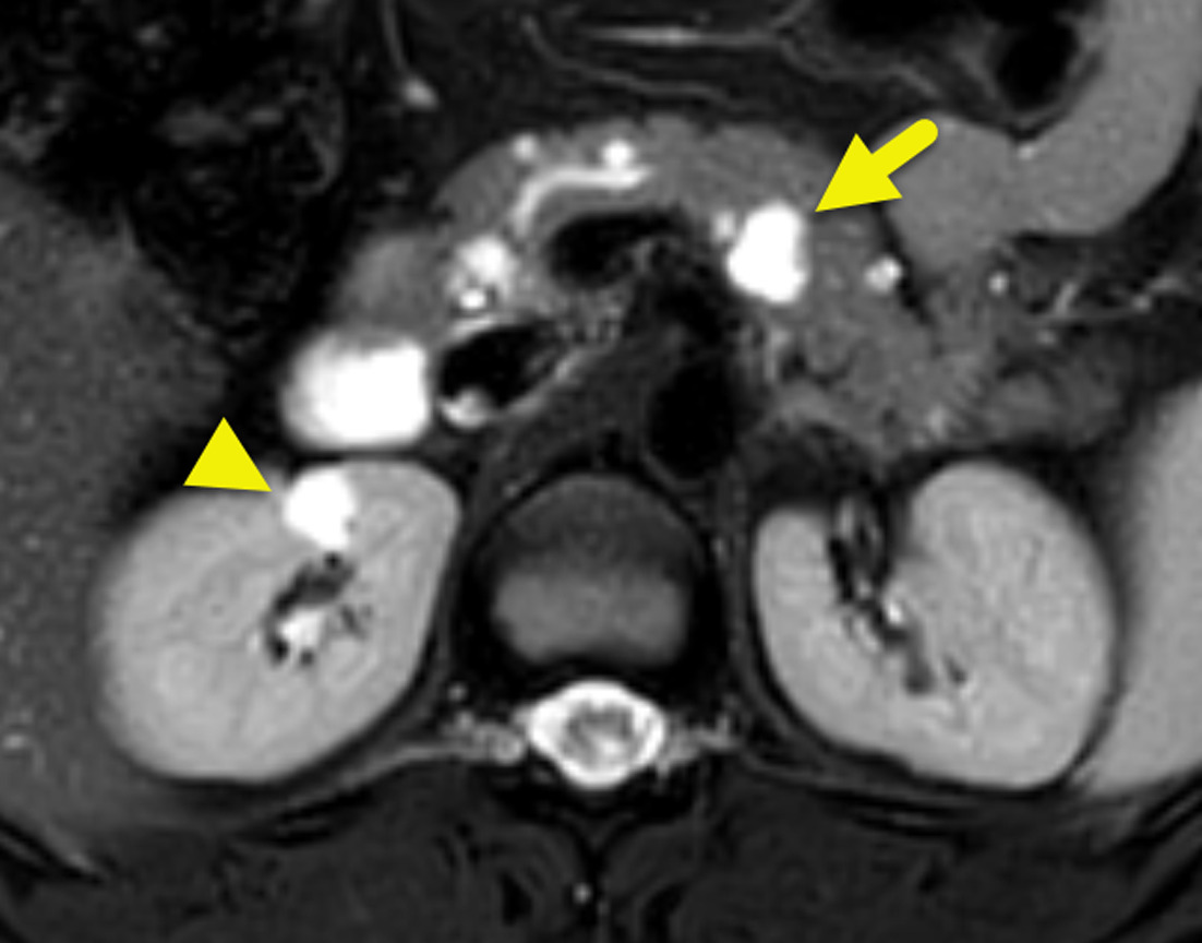 Axial T2-weighted image of the mid abdomen shows cysts within the pancreas (arrow) and right kidney (arrowhead). Additional cysts were present on other images.