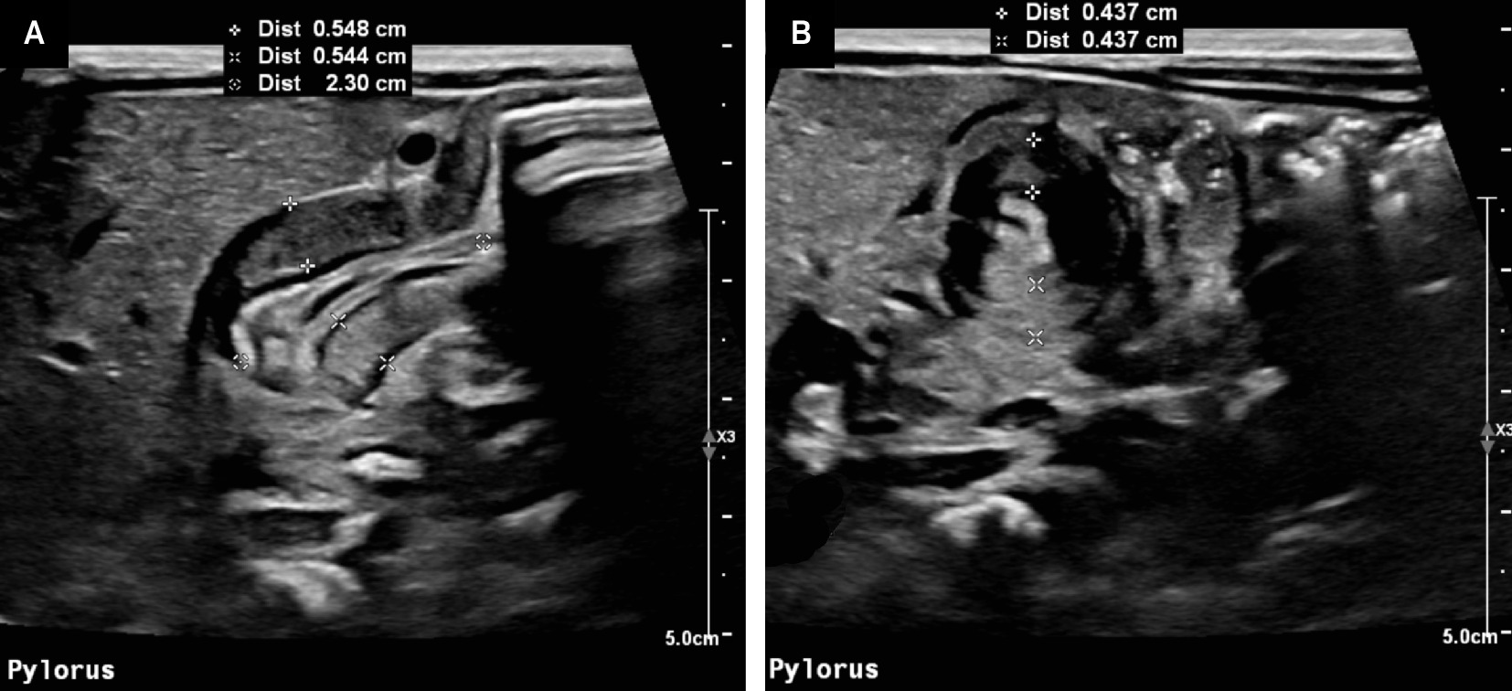(A) Ultrasound of the pylorus in the long axis. The single wall thickness of the pylorus (+) measures 5.5 mm, and the canal is elongated. (B) Ultrasound of the pylorus in the short axis. The single wall thickness of the pylorus (+) measures 4.4 mm.