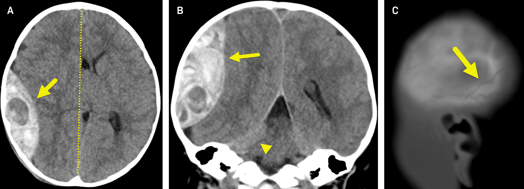 (A) Axial and (B) coronal non-contrast head CT show a large epidural hematoma (arrow) adjacent to the right parietal bone. The hypodense area within the large EH may represent active bleeding. There is a significant mass effect with a right-to-left midline shift (dashed line in A) and a right uncal herniation (arrowhead in B). (C) Sagittal CT image in bone window shows a nondisplaced skull fracture (arrow).