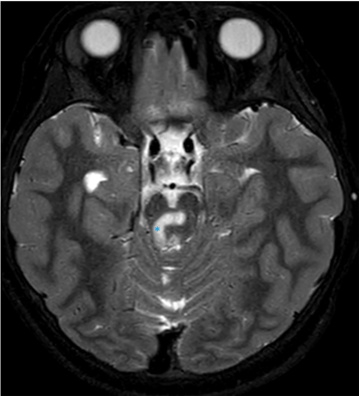 MRI of brain axial T2 mDIXON sequence demonstrating T2 hyperintensity at the pontomesencephalic junction (*).