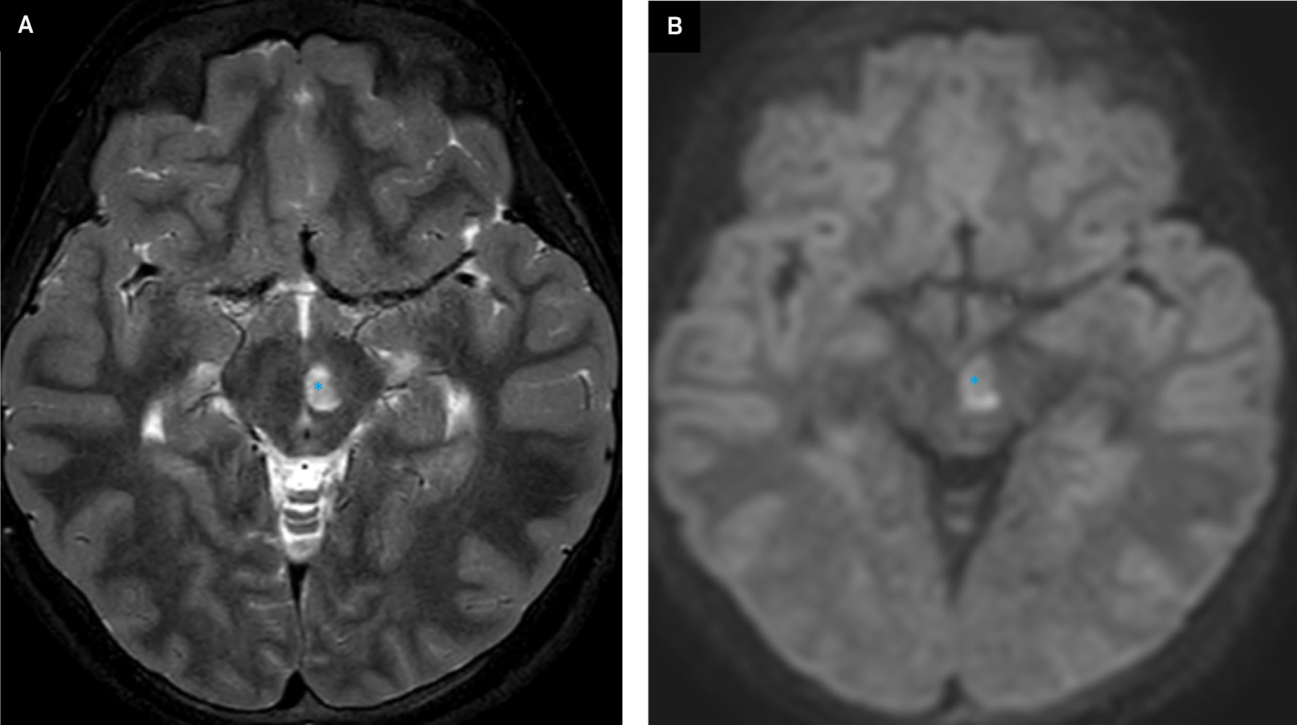 (A) Axial T2 mDIXON sequence with T2 hyperintensity in the left red nucleus (*) associated with abnormal diffusion signal on the B1000 diffusion-weighted sequence (B).