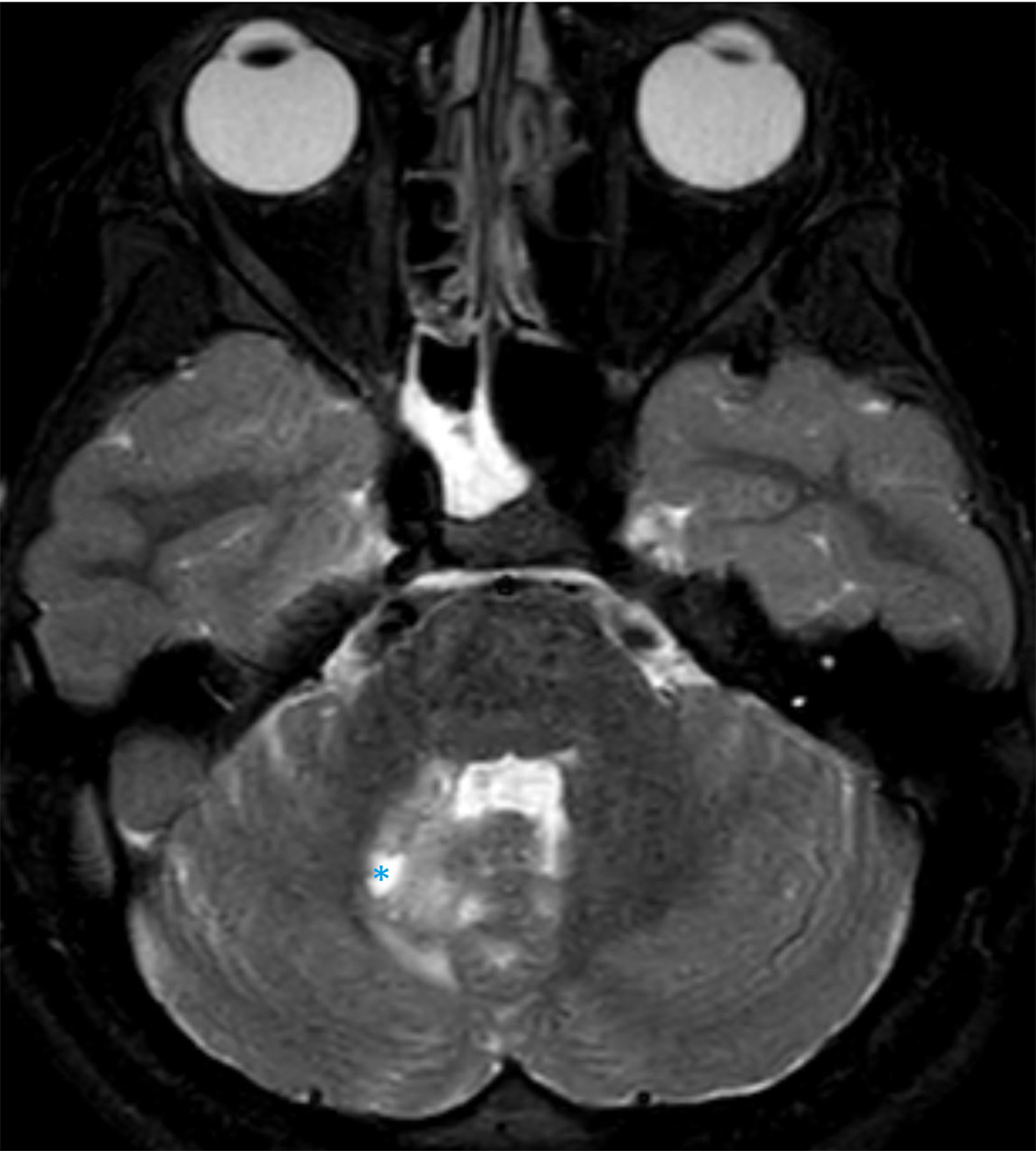 Cystic change (*) and T2 hyperintensity in the medial right cerebellum/dentate nucleus on axial T2 mDIXON sequence.
