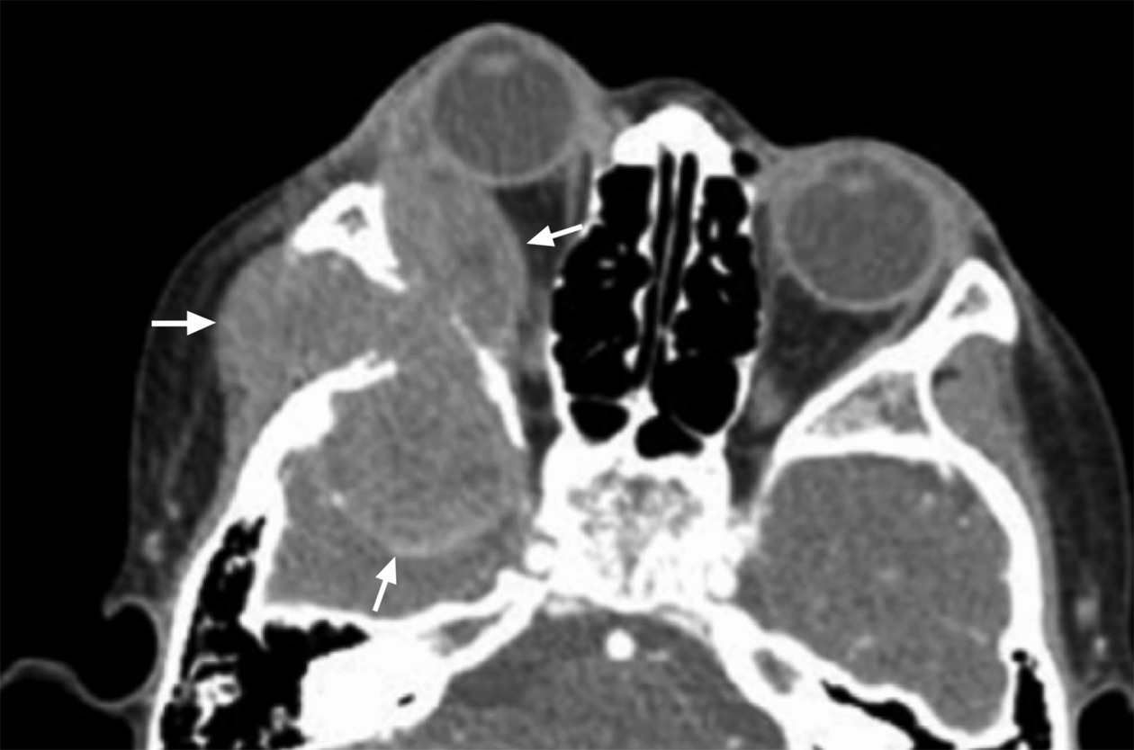 Permeative, metastatic lesion to the lateral orbital wall with soft-tissue masses protruding from the 3 sides of the bone. This is indicative of metastases to the marrow space.