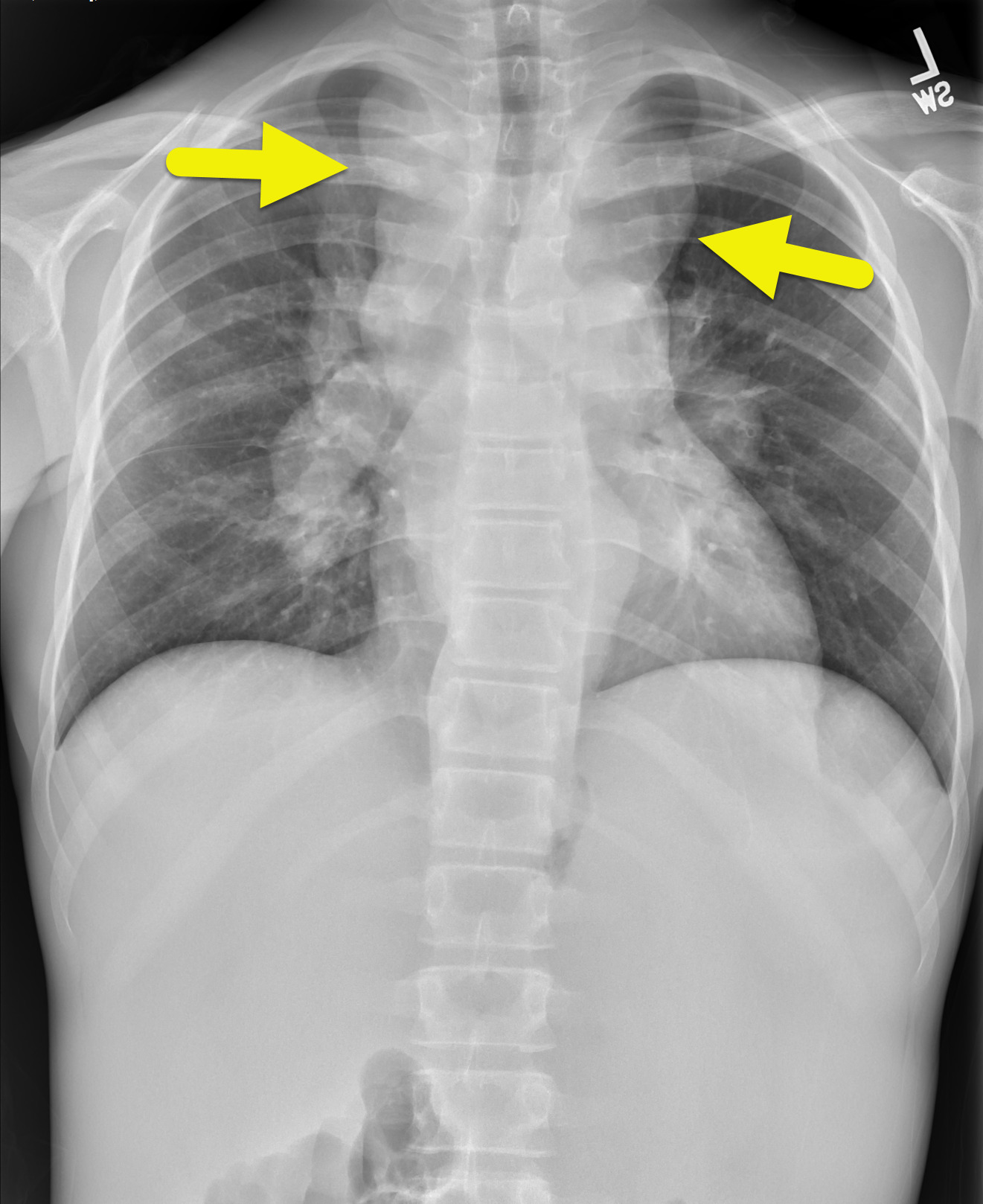Chest radiograph shows a lobulated anterior mediastinal mass (arrow).