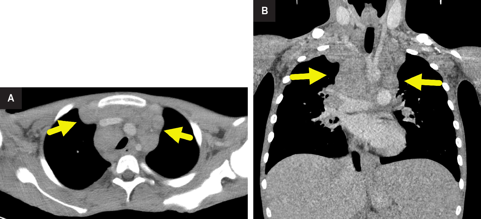 (A) Axial and (B) coronal chest CT shows a conglomerate nodal mass (arrow) of the anterior mediastinum. The mass occupies more than one-third of the thoracic cavity.