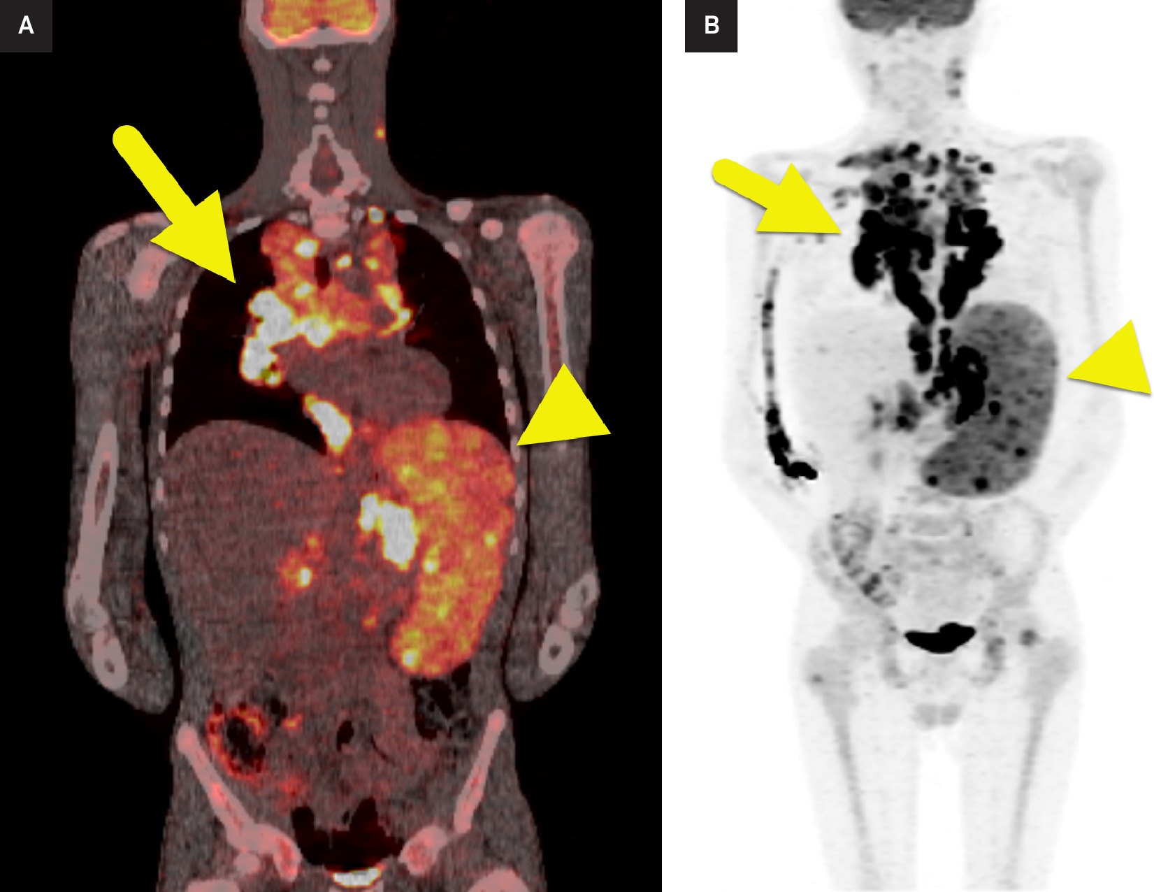 (A) Coronal fused image from F-18 fluorodeoxyglucose (FDG) PET/CT shows a large mediastinal mass with a maximum standardized uptake value of 15. The spleen (arrowhead) is enlarged with FDG uptake. (B) Coronal maximum intensity projection image from the FDG PET shows nodal uptake within the mediastinum extending into the abdomen and mesentery. The spleen (arrowhead) is enlarged. Foci of FDG uptake are also present within the proximal femurs and cervical nodal region.