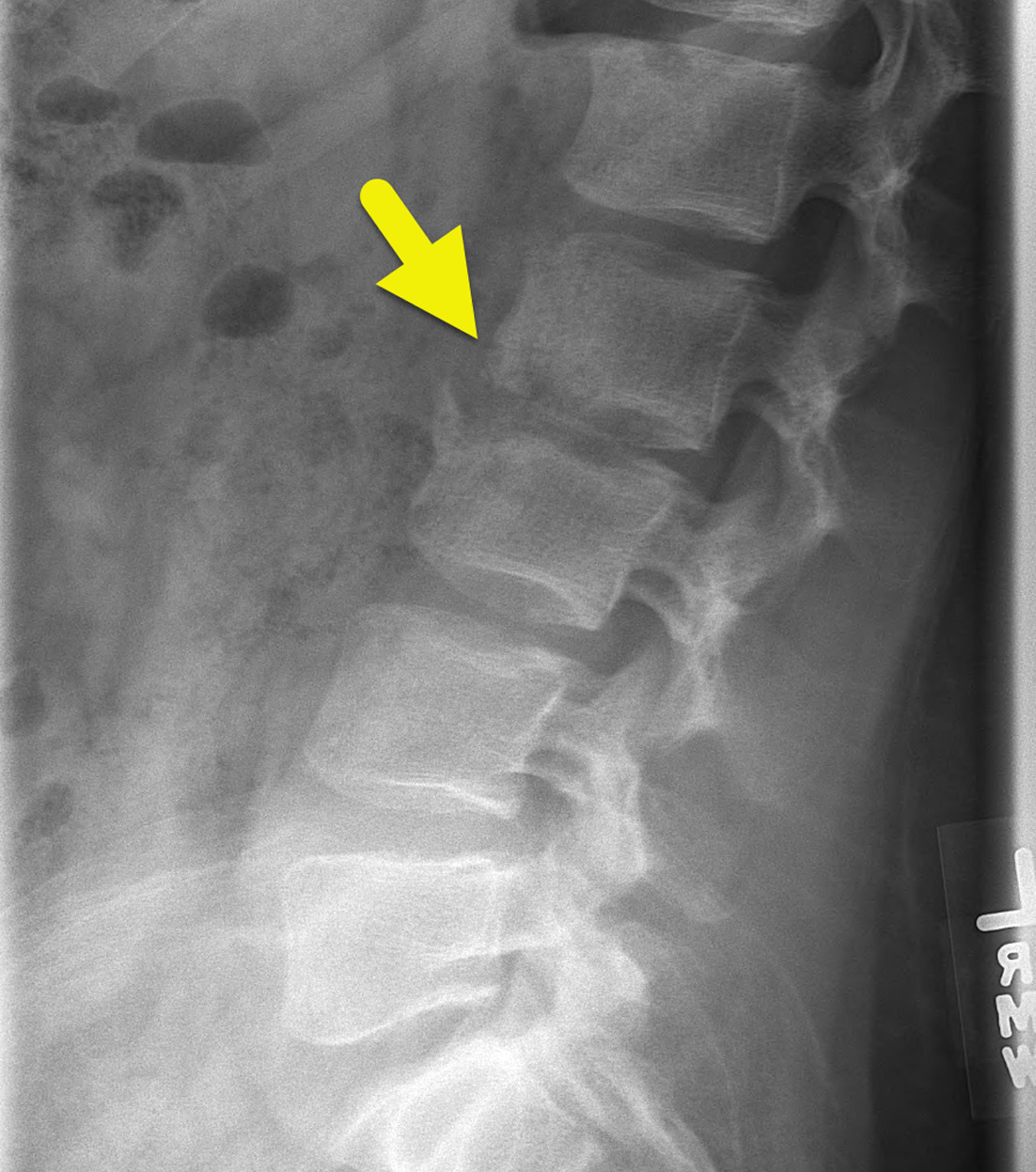 Lateral radiograph of the lumbar spine shows irregularity and narrowing of the intervertebral disc space notching L2-L3 level. There is destruction of the inferior end plate of L2, as well as the superior end plate of L3. Mild fragmentation is present anteriorly.