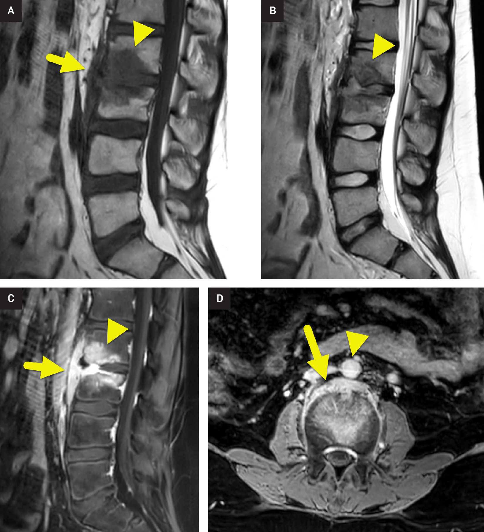 (A) Sagittal T1-weighted, (B) sagittal T2-weighted, and (C) sagittal T1-weighted post-contrast MRI images of the lumbar spine show osteomyelitis affecting the L2 (arrowhead) and L3 vertebral bodies spanning the intervertebral disc space. The intervertebral disc is relatively hypointense on the T1-weighted image and hyperintense on the T2-weighted image. The affected bone is hypointense on both T1- and T2-weighted images and shows diffuse enhancement. The infection extends anterior to the vertebral body column (arrow). (D) Axial T1-weighted post-contrast image shows the prevertebral component of the infection (arrow) uplifting the adjacent abdominal aorta (arrowhead).