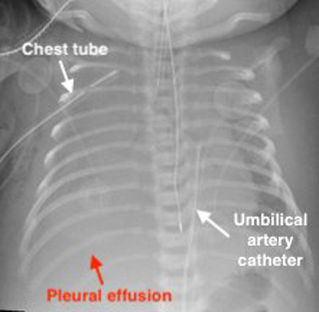 Frontal chest x-ray when the patient was 2 days old demonstrates near complete opacification of the right hemithrorax This finding is consistent with pleural effusion.