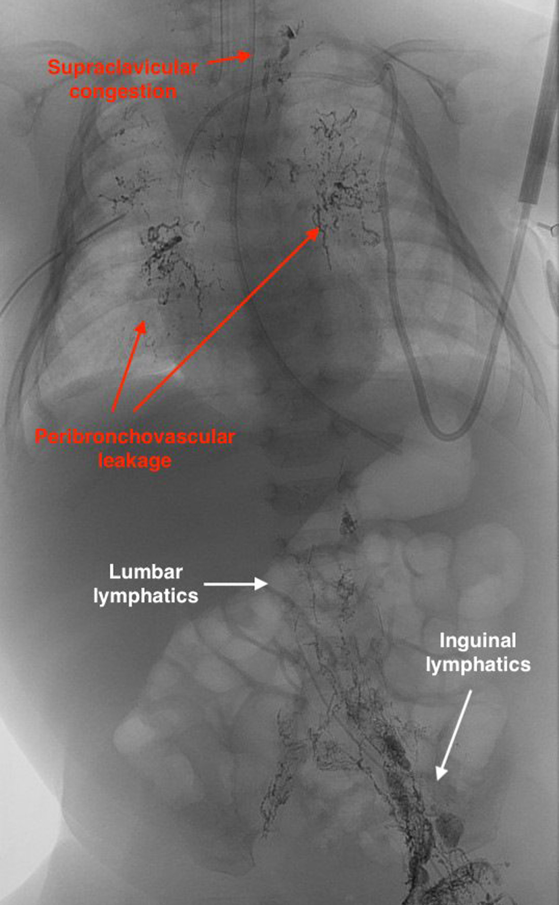 Lymphangiography when the patient was 44 days old demonstrates lymphatic congestion at the left supraclavicular space (short red arrow), as well as bilateral peribronchovascular leakage (long red arrow). This is consistent with congenital conducting lymphatic anomaly. Filling of the lumbar (short white arrow) and inguinal lymphatics (long white arrow) is also noted.