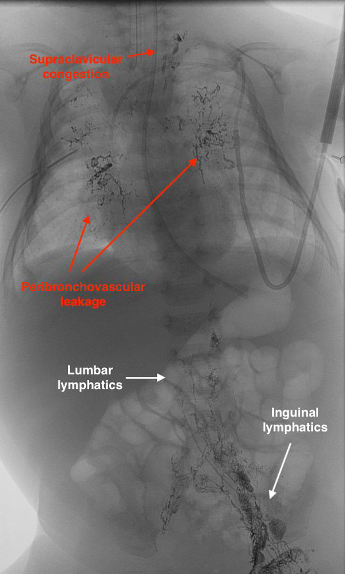 Normal chest x-ray done post-lymphangiography when the patient was 3 months old, representing resolution of the chylothorax. Residual lipiodol is seen in the mediastinum and cervical lymph nodes bilaterally.