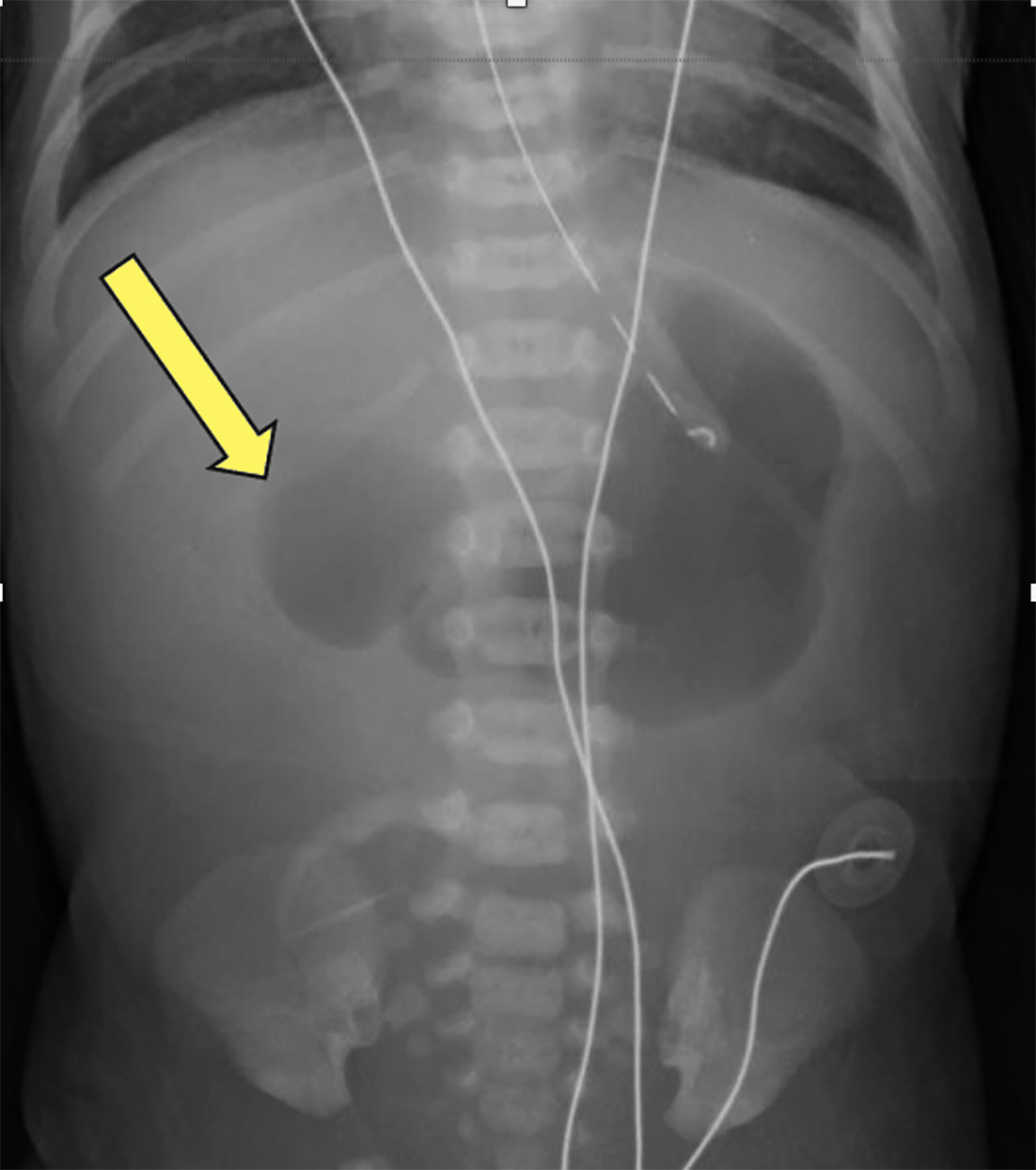Abdominal radiograph shows a double bubble with a distended stomach and first segment of duodenum (arrow). Note the absence of any distal bowel gas.