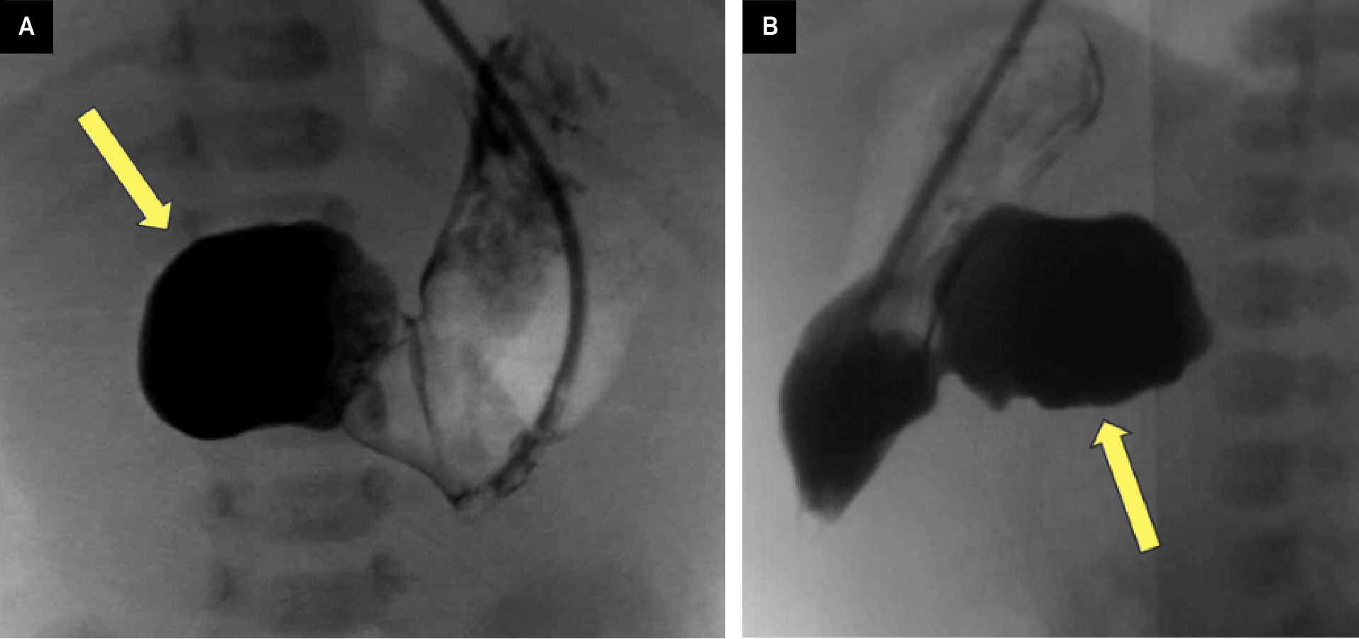 (A) AP and (B) lateral images from upper gastrointestinal examination show contrast within the stomach and markedly dilated proximal duodenum (arrow). There is no passage of contrast into the distal bowel loops.