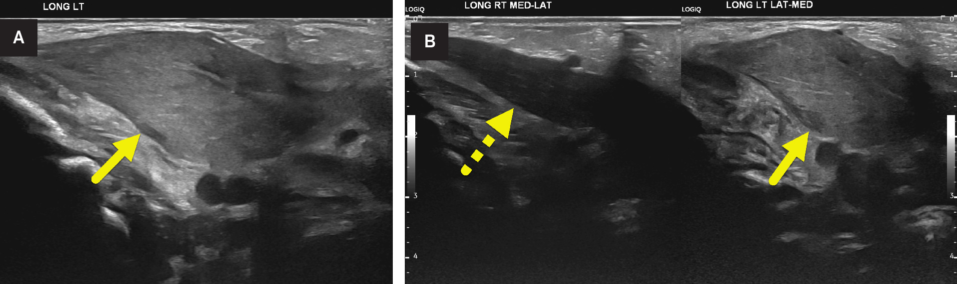 (A) Longitudinal US image of the left neck shows fusiform enlargement and increased echogenicity of the left sternocleidomastoid muscle (arrow). (B) Side-by-side comparison of longitudinal images of the neck shows the difference between the normal left (arrow) and enlarged fusiform-shaped right (dashed arrow) sternocleidomastoid muscles.