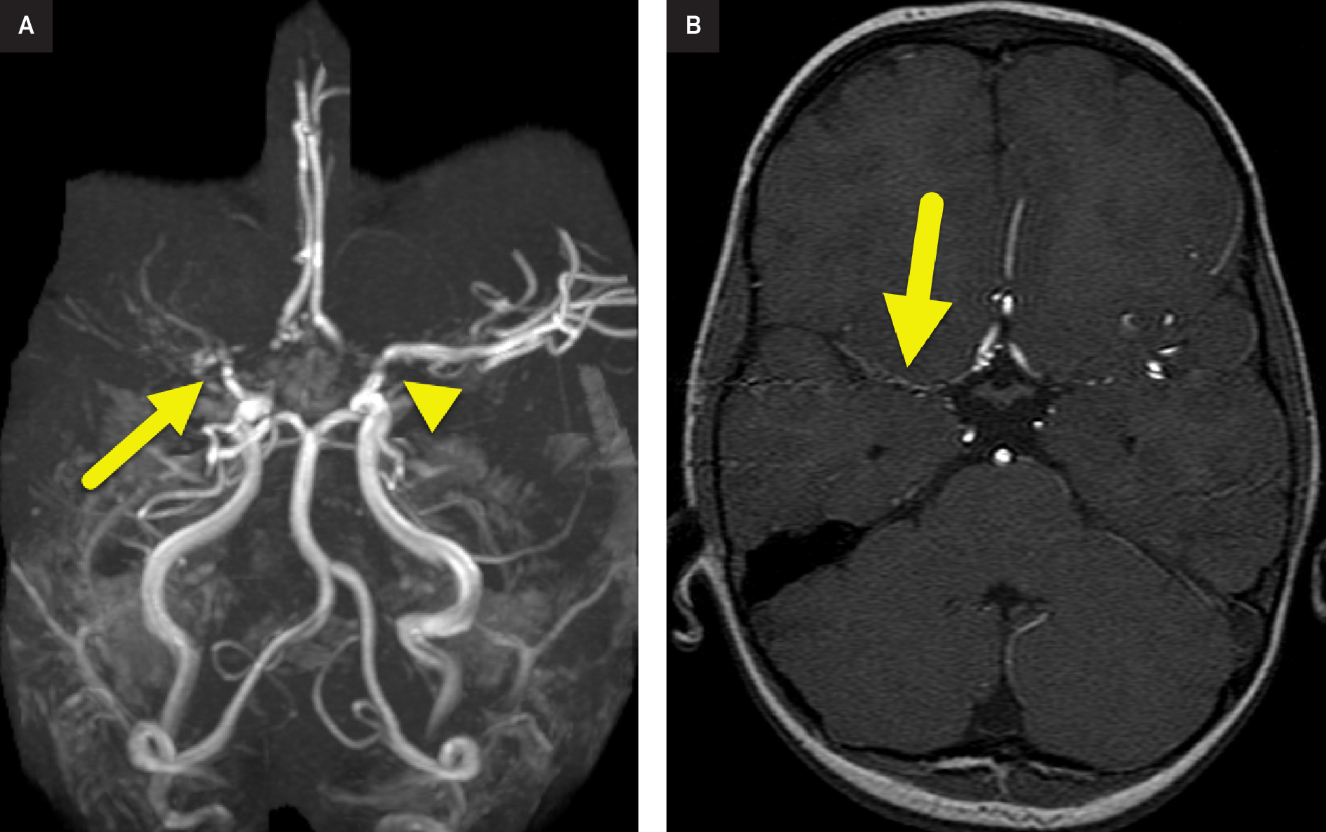(A) Oblique coronal 3D reformat from MR angiogram shows high-grade stenosis (arrow) at the bifurcation of the right internal carotid artery and moderate stenosis (arrowhead) at the bifurcation of the left internal carotid artery. Small collateral vessels are present on the right. (B) Axial source image from time-of-flight MR angiogram shows the small collateral vessels (arrow) in the distribution of the right middle cerebral artery.