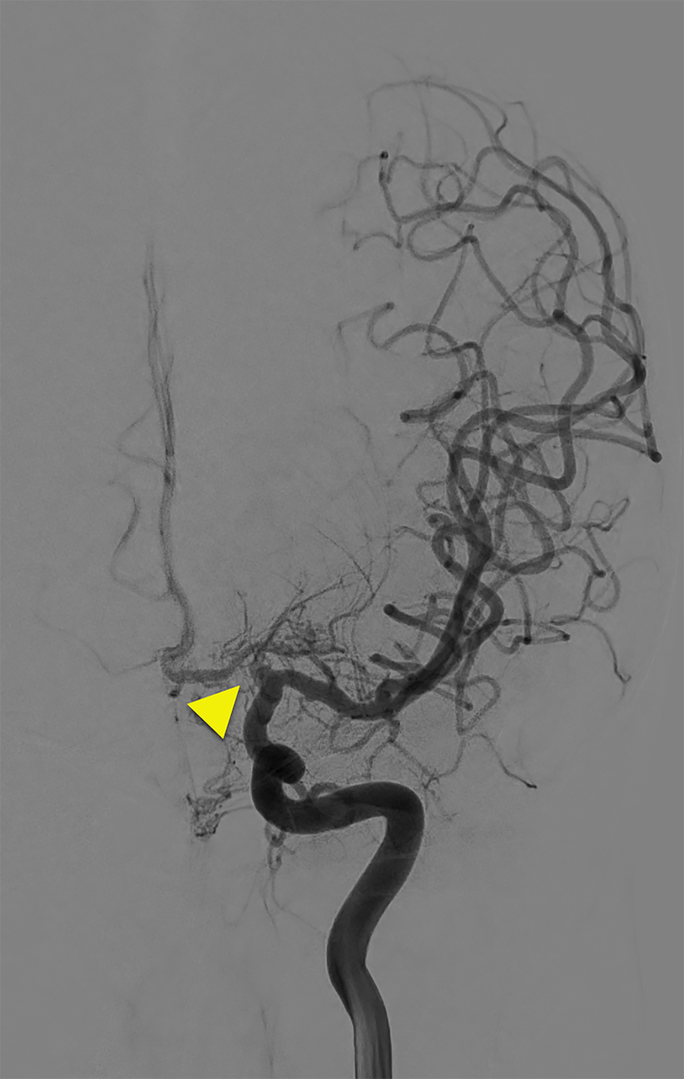 Digital subtraction angiogram performed 15 years after the original MR angiogram and after revascularization surgery shows narrowing of the A1 segment (arrow) of the left anterior cerebral artery. Reconstituted flow is present within the left middle cerebral artery.