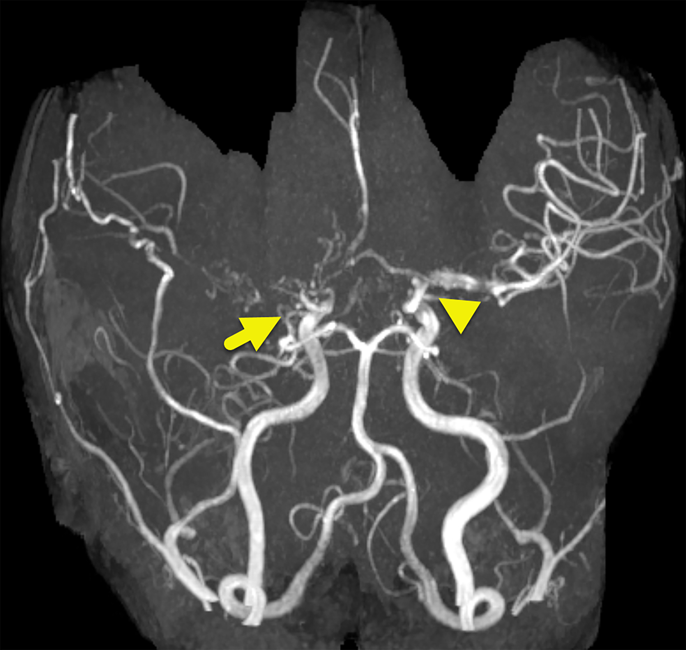 Oblique coronal 3D reformat from MR angiogram shows occlusion (arrow) at the bifurcation of the right internal carotid artery and moderate stenosis (arrowhead) at the bifurcation of the left internal carotid artery. Small collateral vessels are present on the right. Flow extends intracranially from the right external carotid artery via parietal superficial temporal artery pial synangiosis.