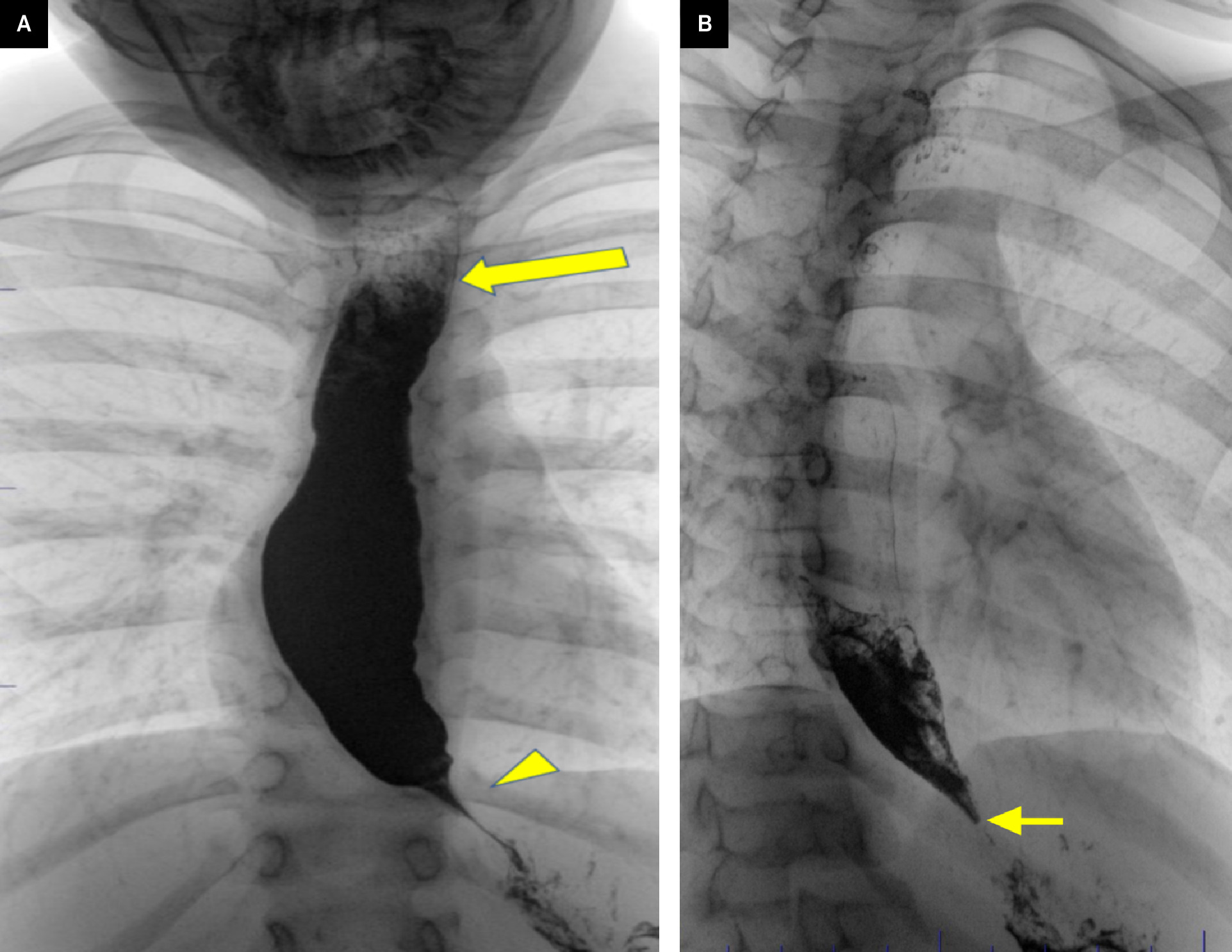 (A) Frontal view of the esophagus during the upper gastrointestinal fluoroscopy exam. The esophagus is dilated with a barium/fluid level in the upper esophagus (arrow) and narrowed “bird beak” configuration at the gastroesophageal junction (arrowhead). (B) Oblique image demonstrating delayed esophageal emptying with diminished peristalsis with residual food-fluid/barium in the distal esophagus.