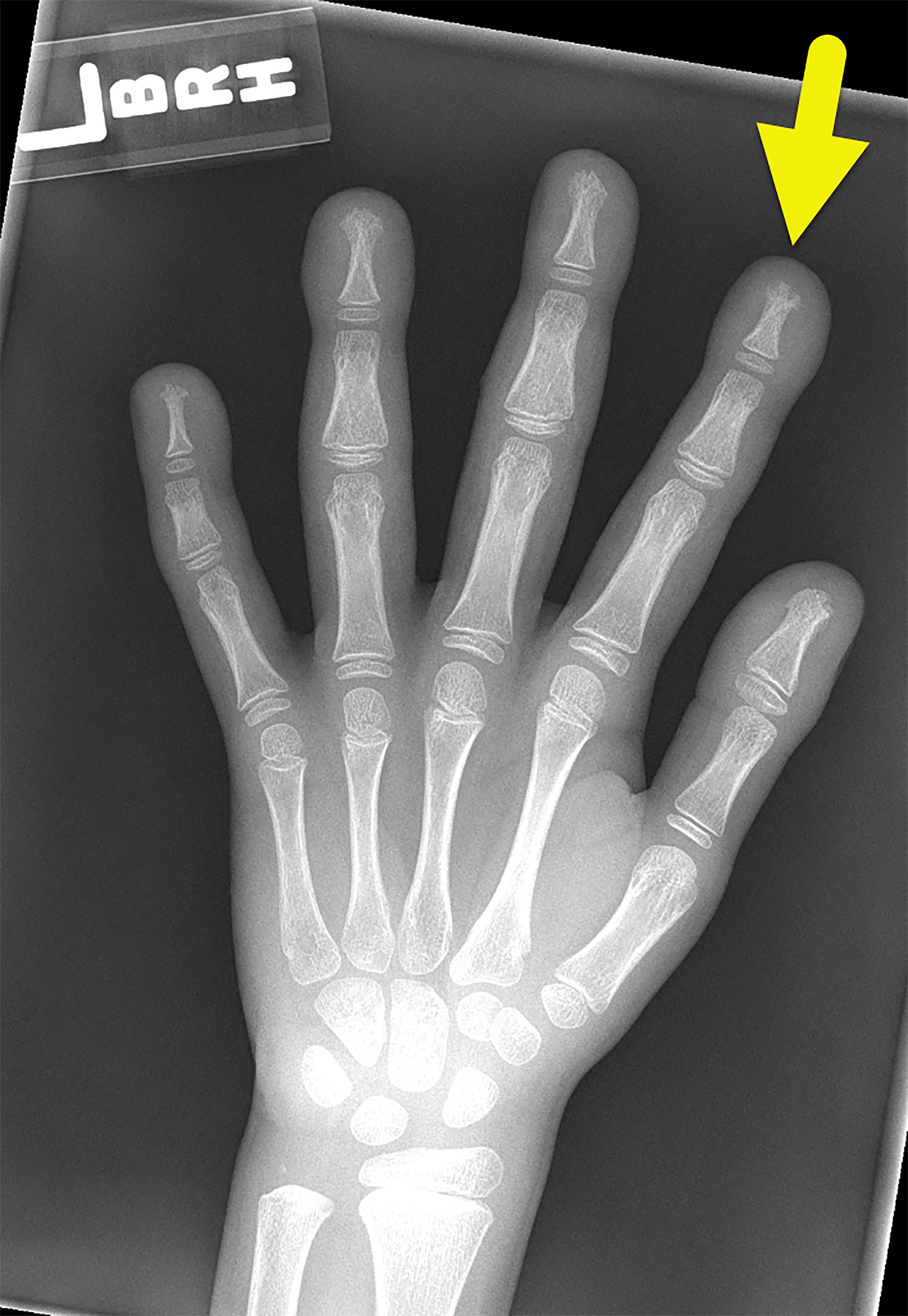 A radiograph of the left hand in a 7-year-old shows symmetric soft-tissue swelling, prominence of the distal phalanges of both hands. In addition, there are early findings of acroosteolysis (arrow), which is the greatest at the tuft of the index finger of the left hand.
