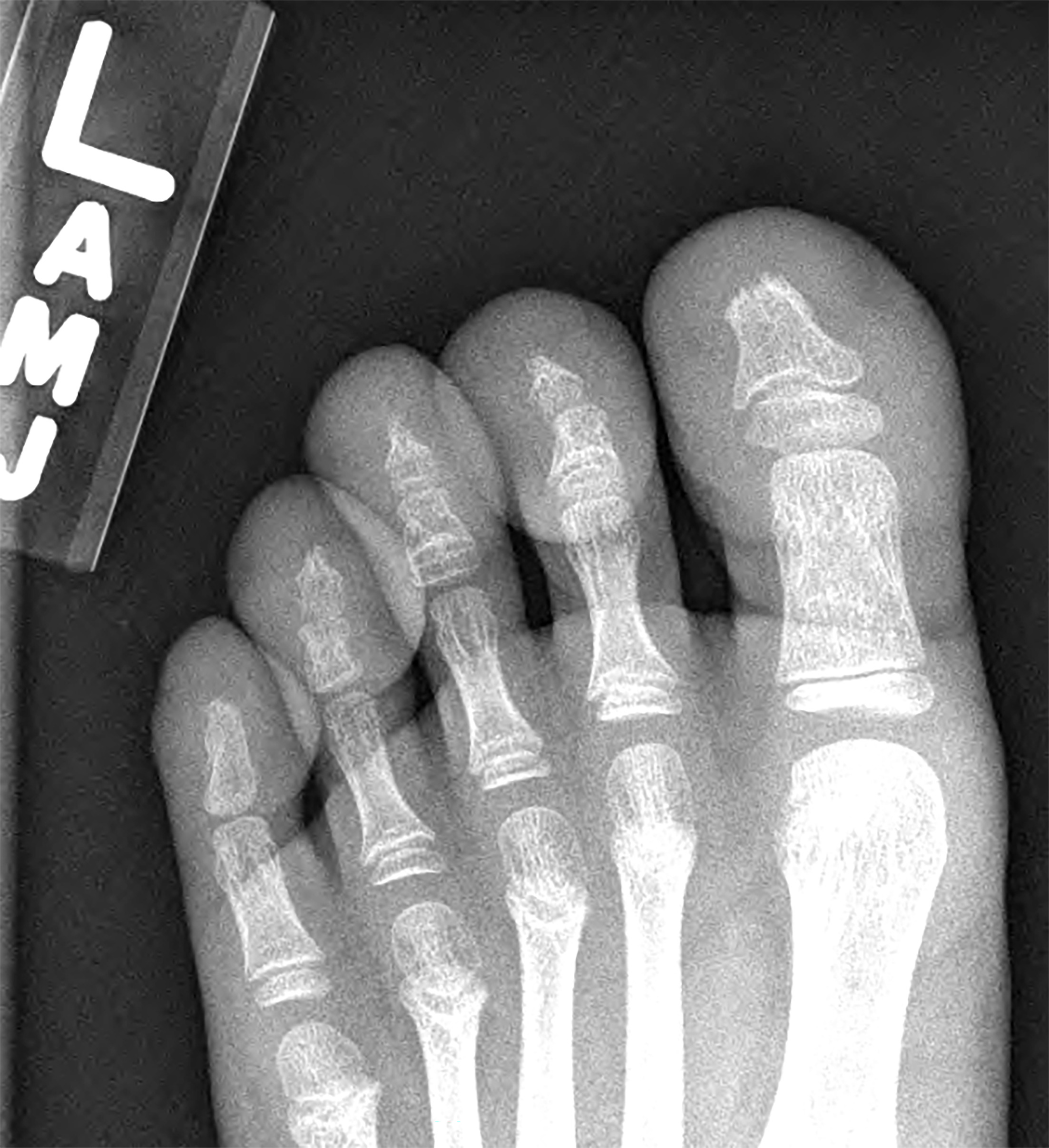 Findings are bilateral but only the left side is shown. A radiograph of the foot shows loss of the tuft of the distal phalanx of both great toes, left greater than right. There is a conical shape/pencil deformity of the distal phalanx of the 2nd-4th digits bilaterally. The distal phalanx of the 5th digit appears normal with less soft-tissue swelling of the left 5th digit distally. Soft-tissue swelling over distal phalanges of the right first through 5th digit and left first through 4th digit is seen.
