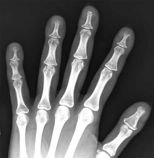 Findings are bilateral but only the left side is shown. A radiograph of the left hand 8 years later shows progression of the findings with fragmentation of the tuft of the distal phalanx of the left small finger. There is fragmentation and resorption of the distal tufts of all digits with lesser involvement of the distal phalanges of both thumbs.