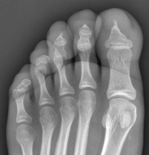 A radiograph of the left foot 8 years later shows progression of the findings with erosion of the distal tufts of the toes.