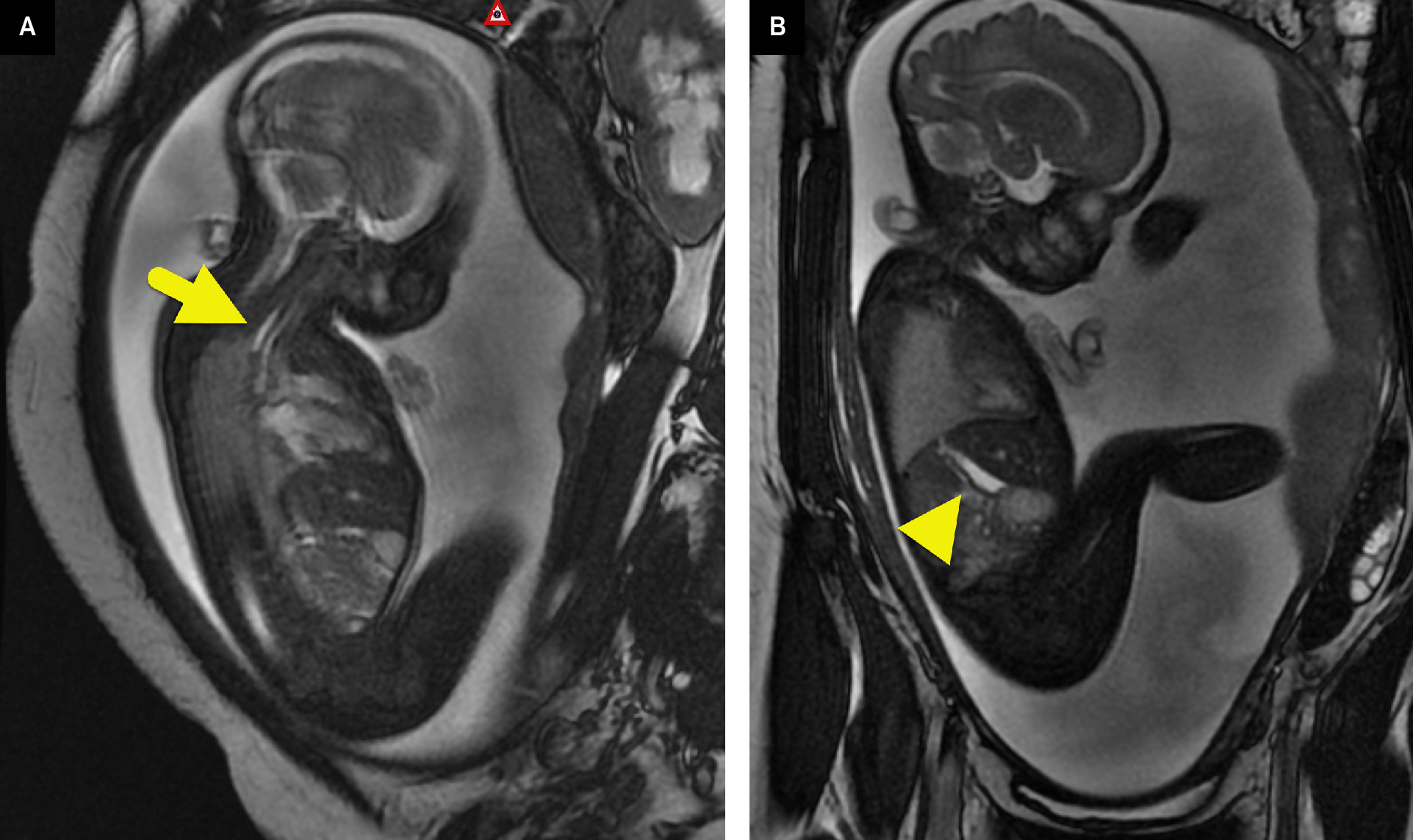 (A) Sagittal T2-weighted images from fetal MRI show polyhydramnios and a dilated proximal esophageal pouch (arrow) just posterior to the fluid-filled trachea. (B) A small amount of fluid is present within the stomach (arrowhead).