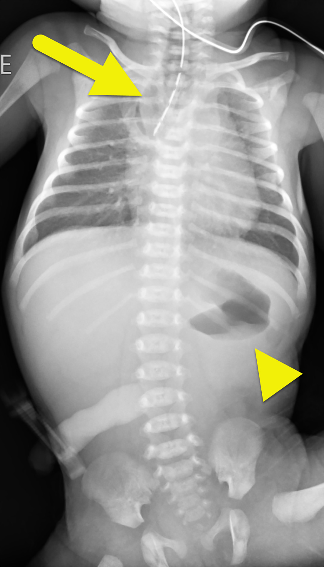 A radiograph of the chest and abdomen obtained immediately after birth shows a Replogle tube within the dilated and air-filled proximal esophageal pouch (arrow). Air is also present within the stomach (arrowhead). Small bowel loops are not yet filled with air.
