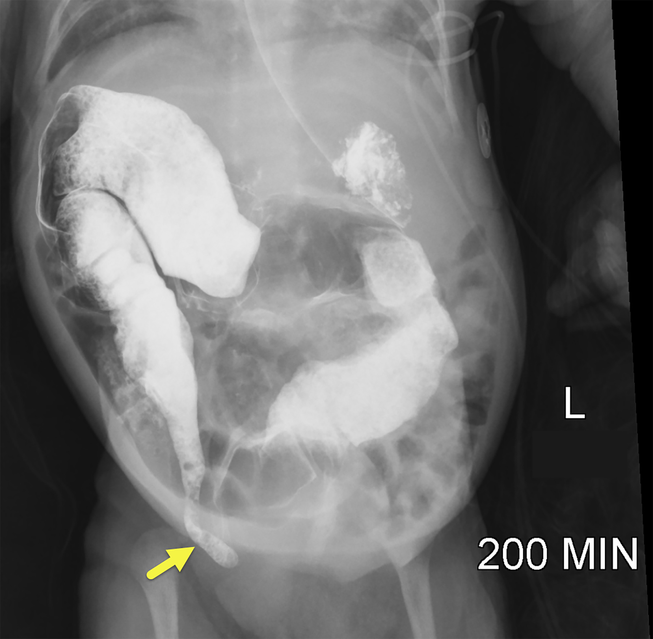 Delayed image from upper GI with small bowel follow-through shows the appendix (arrow) extending to the right inguinal canal.
