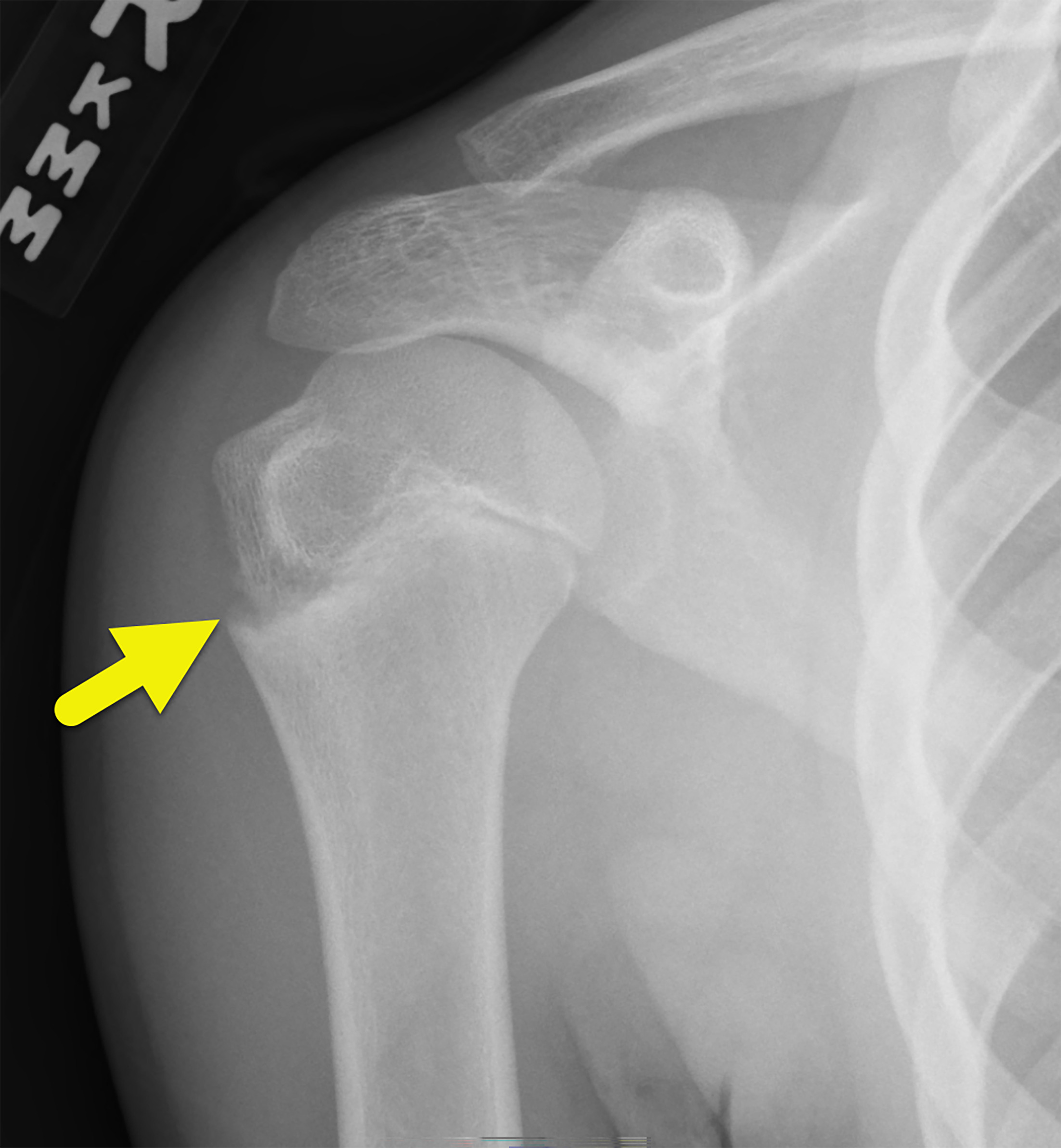 A radiograph of the right shoulder showing widening and irregularity (arrow) of the lateral aspect of the proximal humerus physis in a patient with little league shoulder.