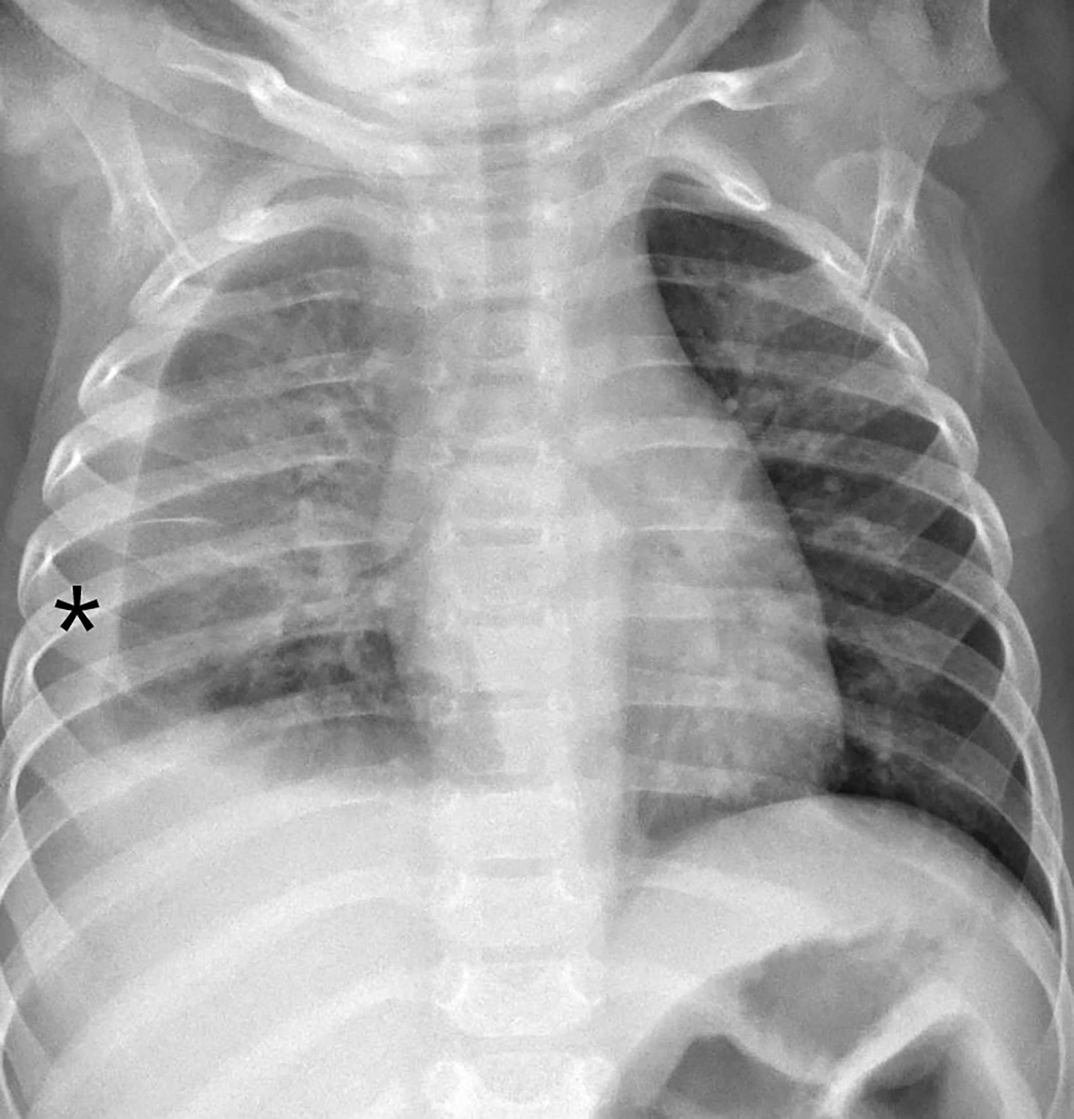 A frontal chest radiograph demonstrating the presence of a moderate-sized right pleural effusion (asterisk) and right lower lobe pneumonia or atelectasis.