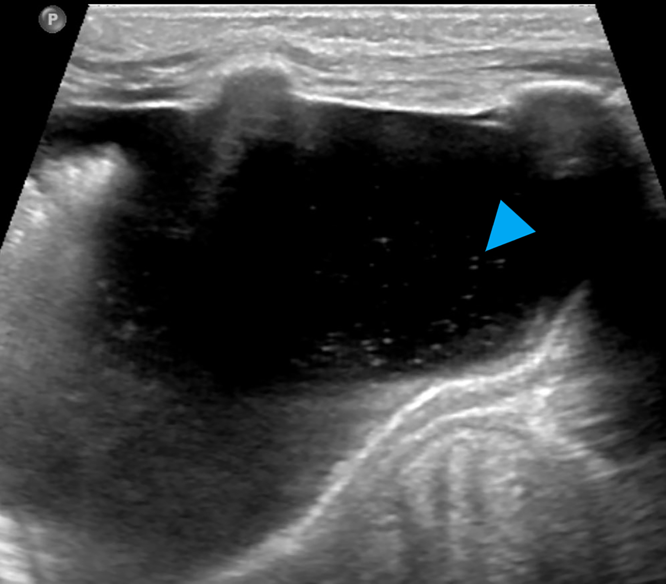 US of the left chest demonstrating the presence of a simple but large pleural effusion, containing mobile low-level internal echoes (arrowhead).