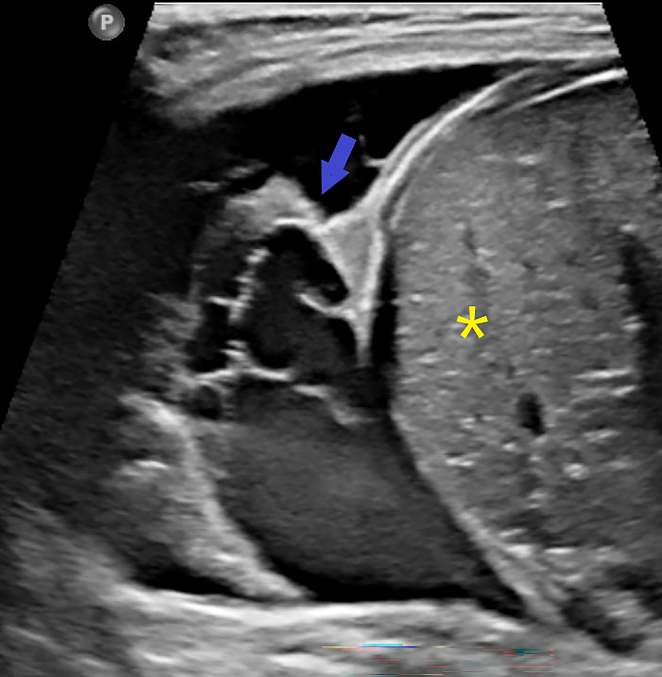 US of the right chest in the sagittal plane demonstrating the presence of a complex pleural effusion with thick septations (blue arrow) in the lower thorax. The liver is demarcated with a yellow asterisk.