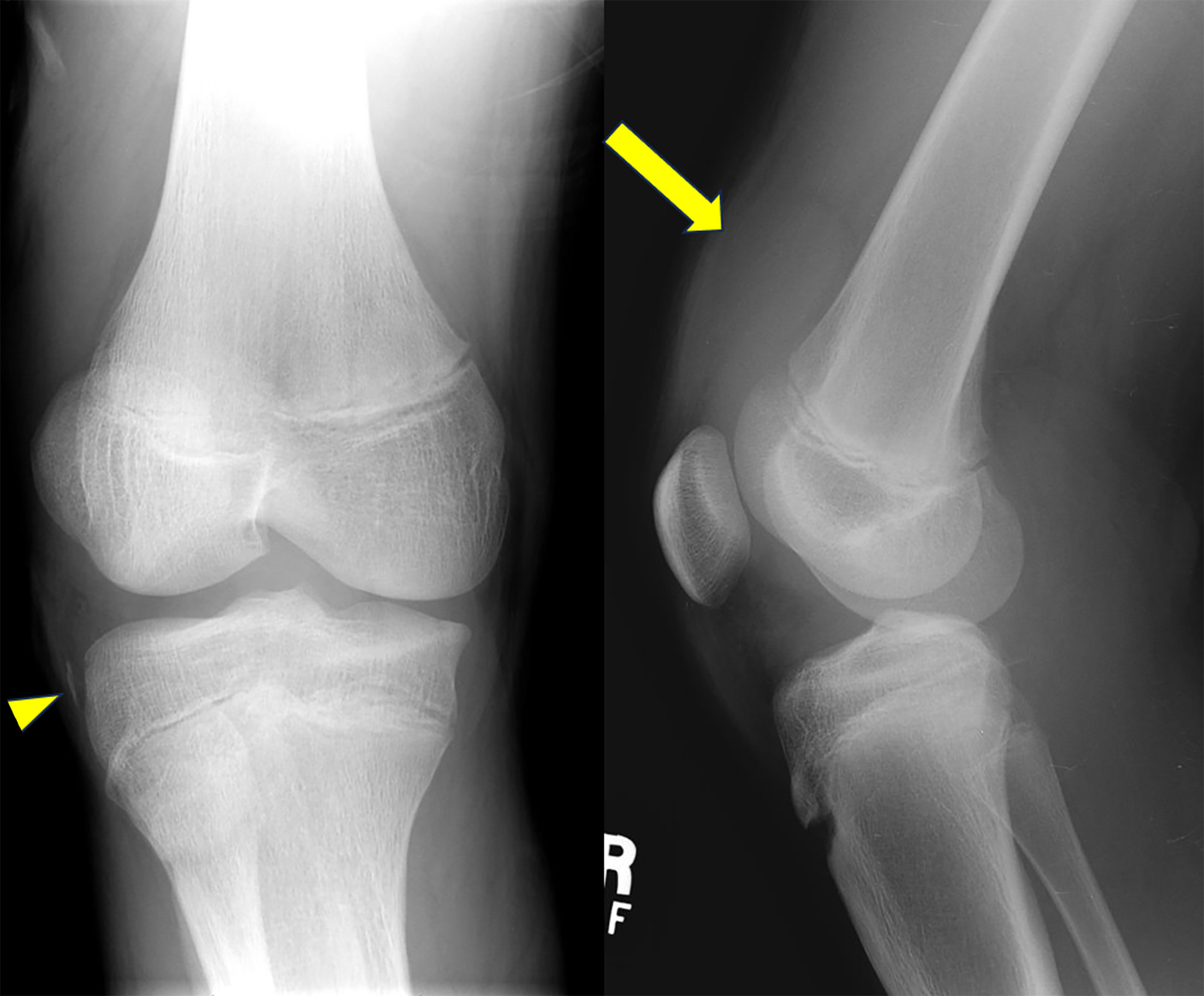 Anteroposterior and lateral radiographs of the right knee showing large joint effusion (arrowhead) and linear avulsion fracture fragment of the lateral tibial cortex (arrow).