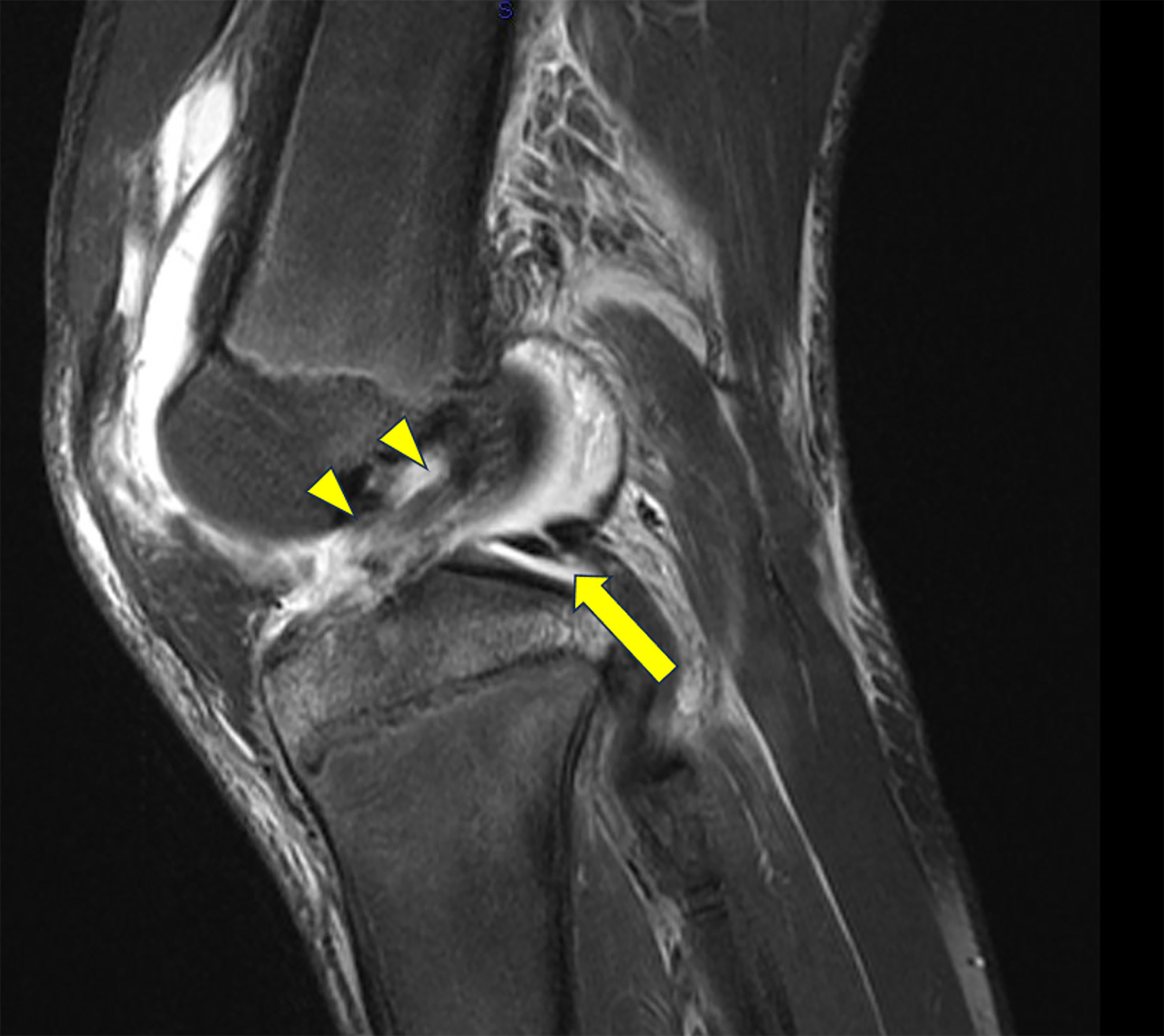 Sagittal T2-weighted fat-saturated MRI image showing complete tear of the anterior cruciate ligament (arrowheads) and vertical oblique tear of posterior horn of lateral meniscus (arrow).