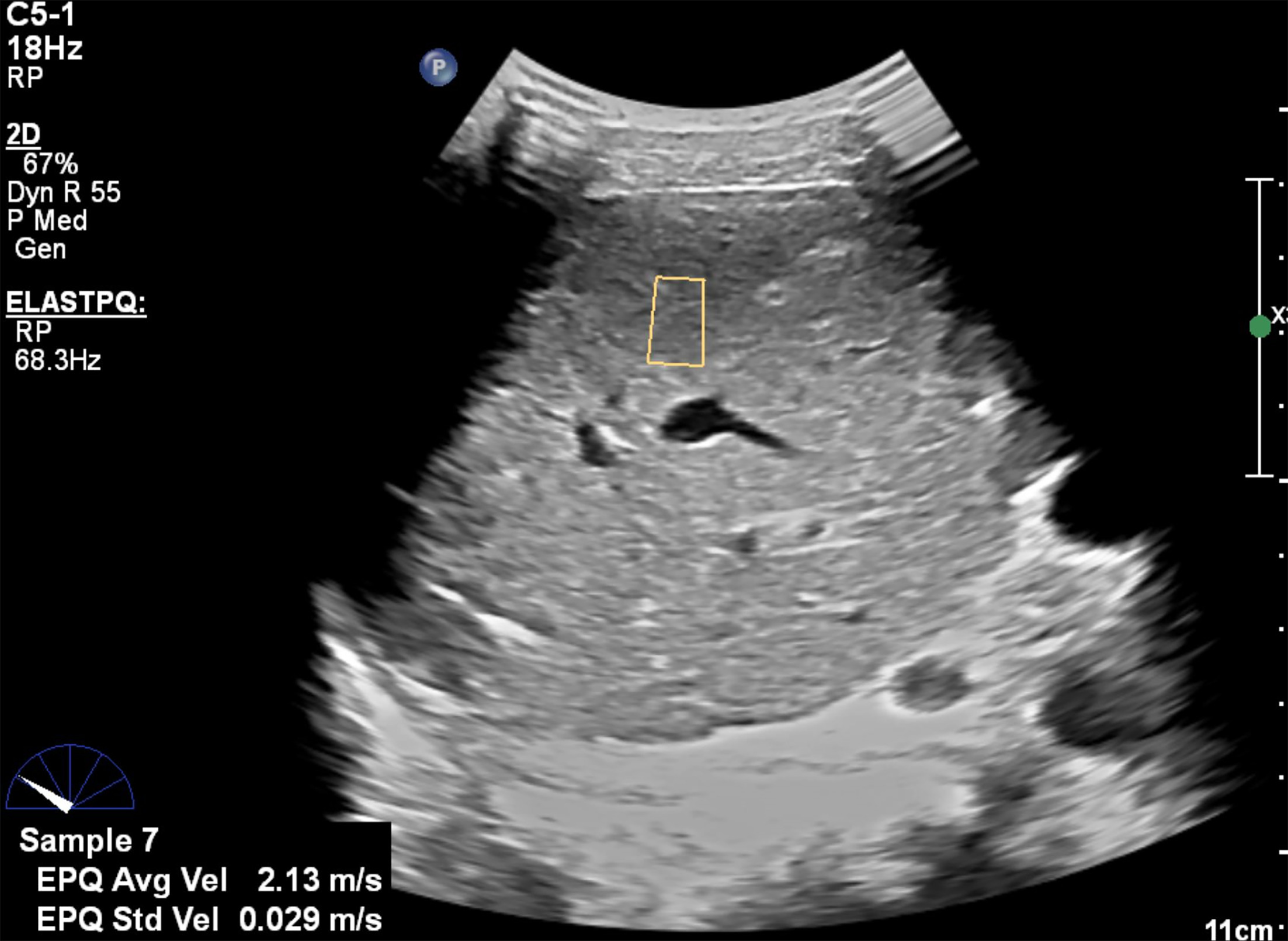 Liver US with shear wave elastography measurement in the right lobe of the liver.