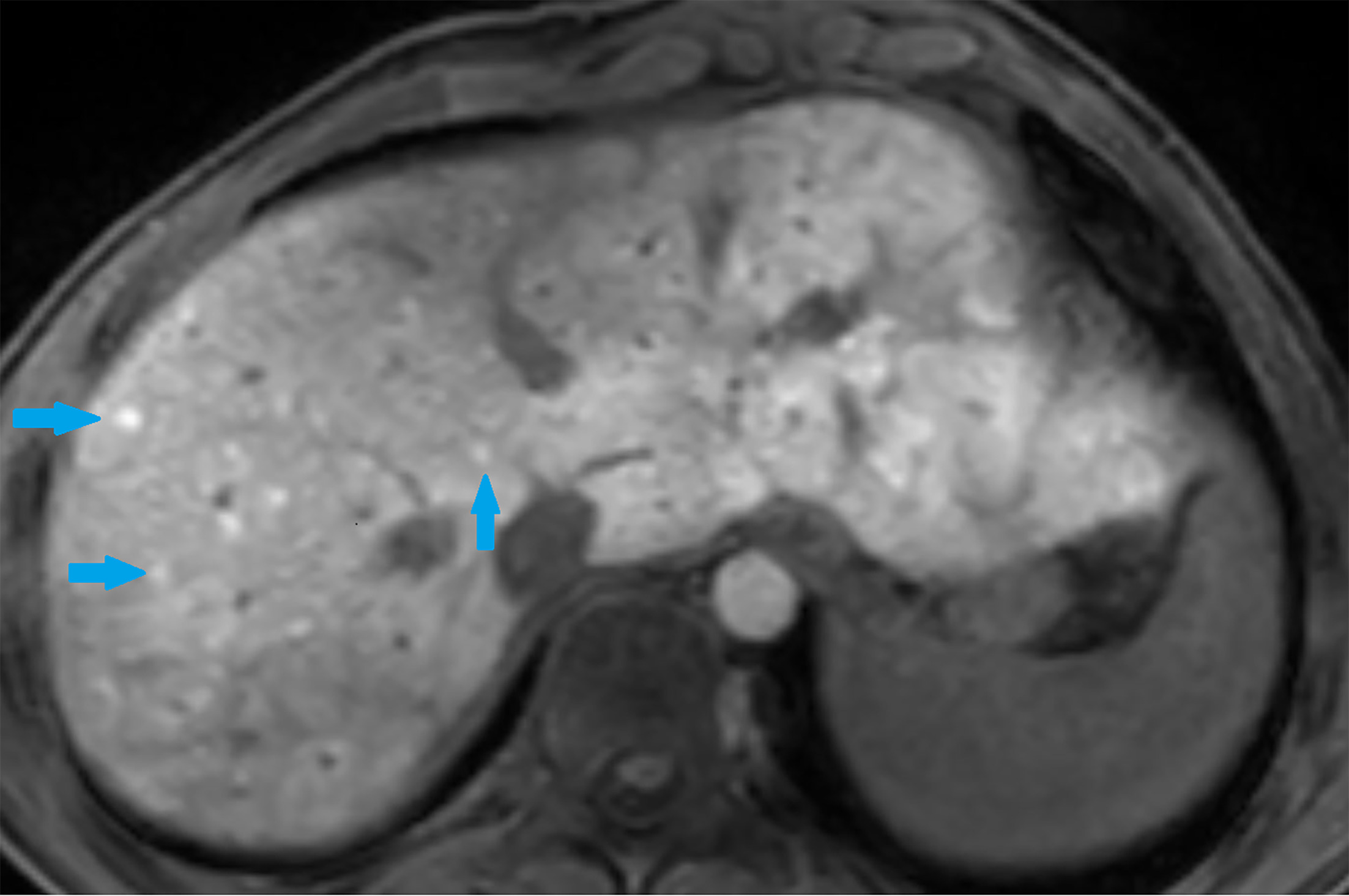 AX T1 XD post-contrast MR of the liver at 30 minutes demonstrates innumerable sub-centimeter foci with enhancement that is greater than the background liver, suggesting focal nodular hyperplasia-like lesions (blue arrows).