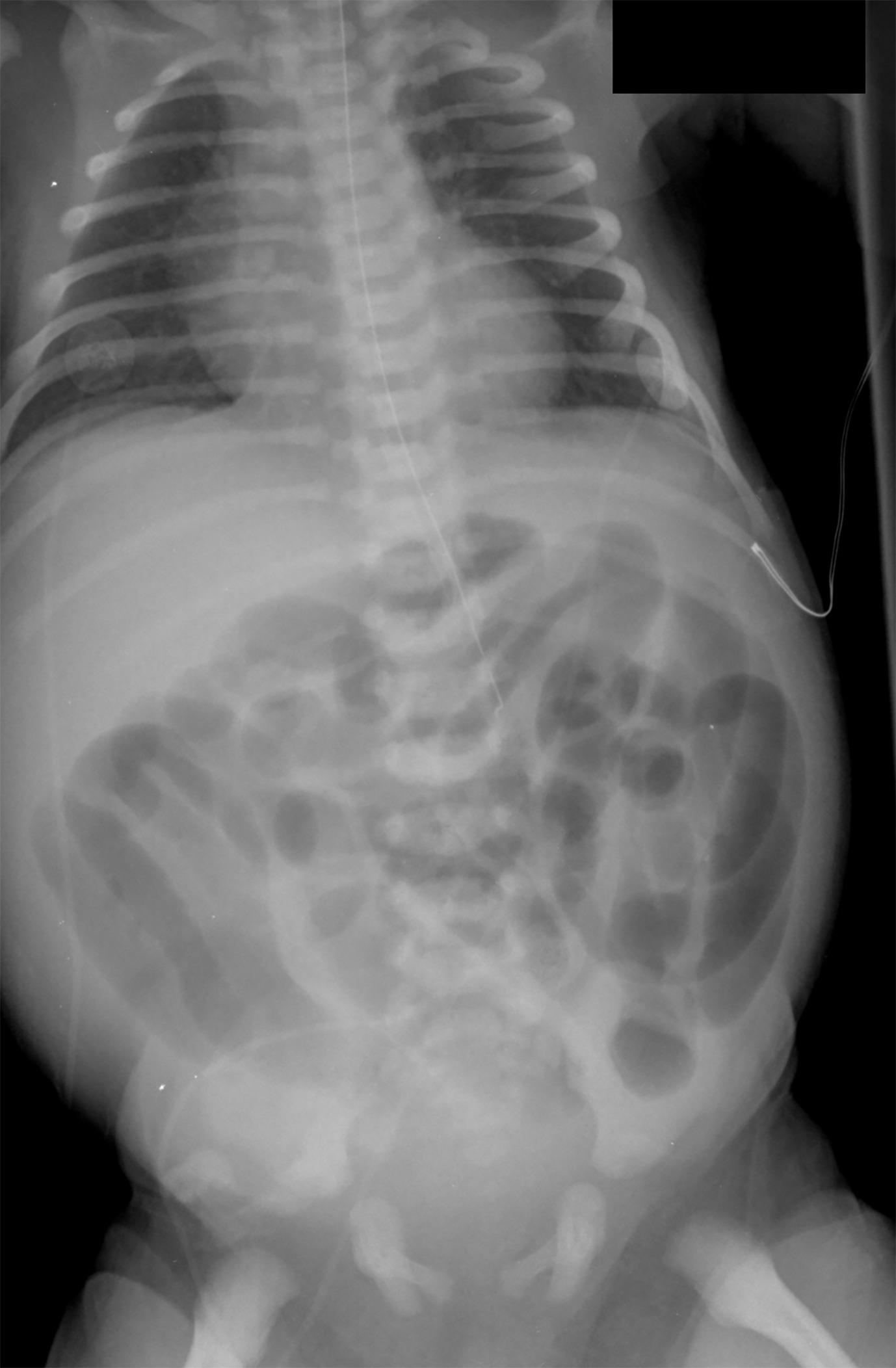 Abdominal radiograph showing dilated air-filled loops of bowel throughout the abdomen consistent with a distal bowel obstruction.