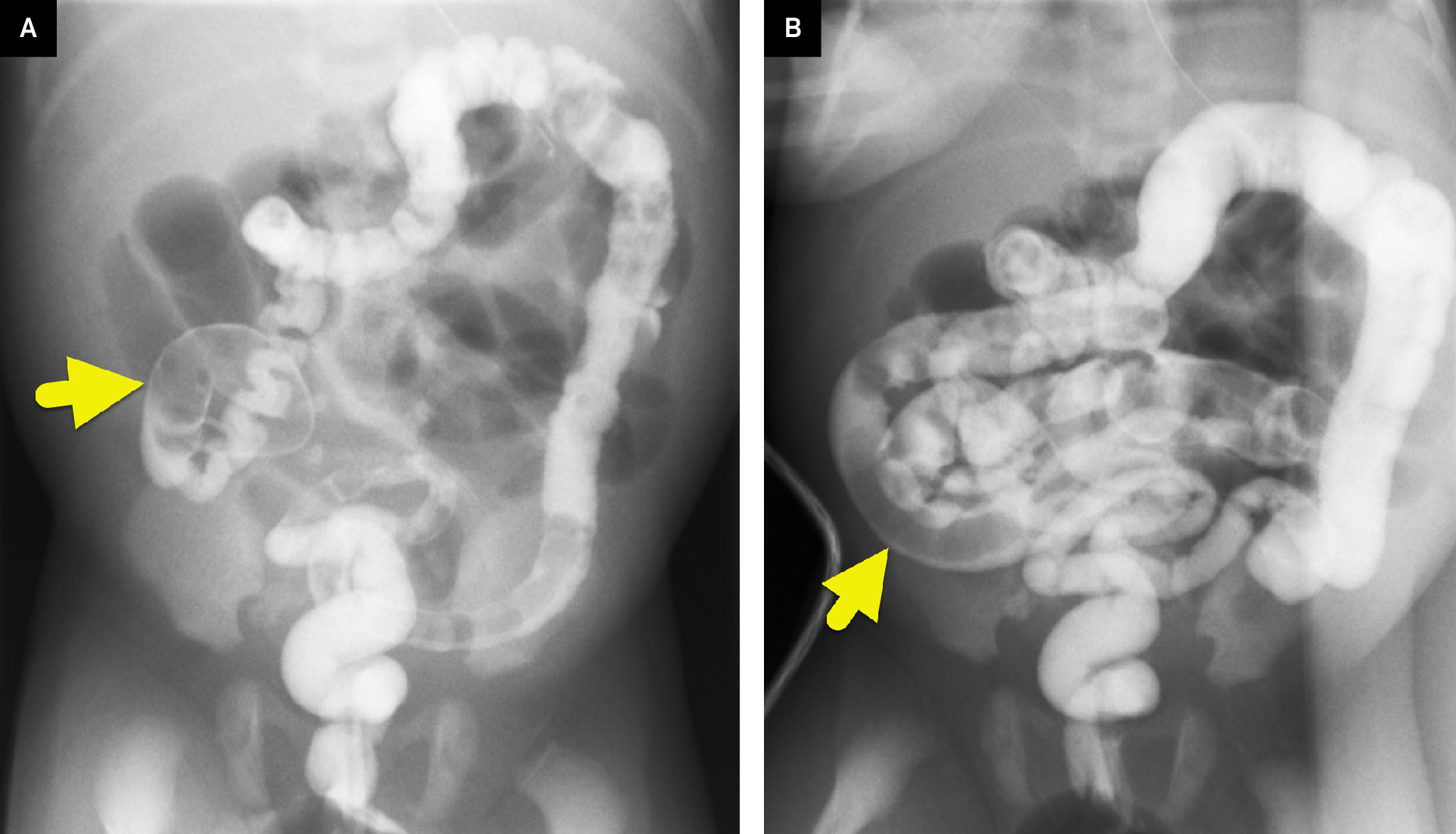 (A, B) Sequential images from a contrast enema showing a small-caliber colon and filling defects (arrow) of meconium in the terminal ileum. The ileal loops of bowel are dilated, showing that contrast has extended beyond the site of obstruction.
